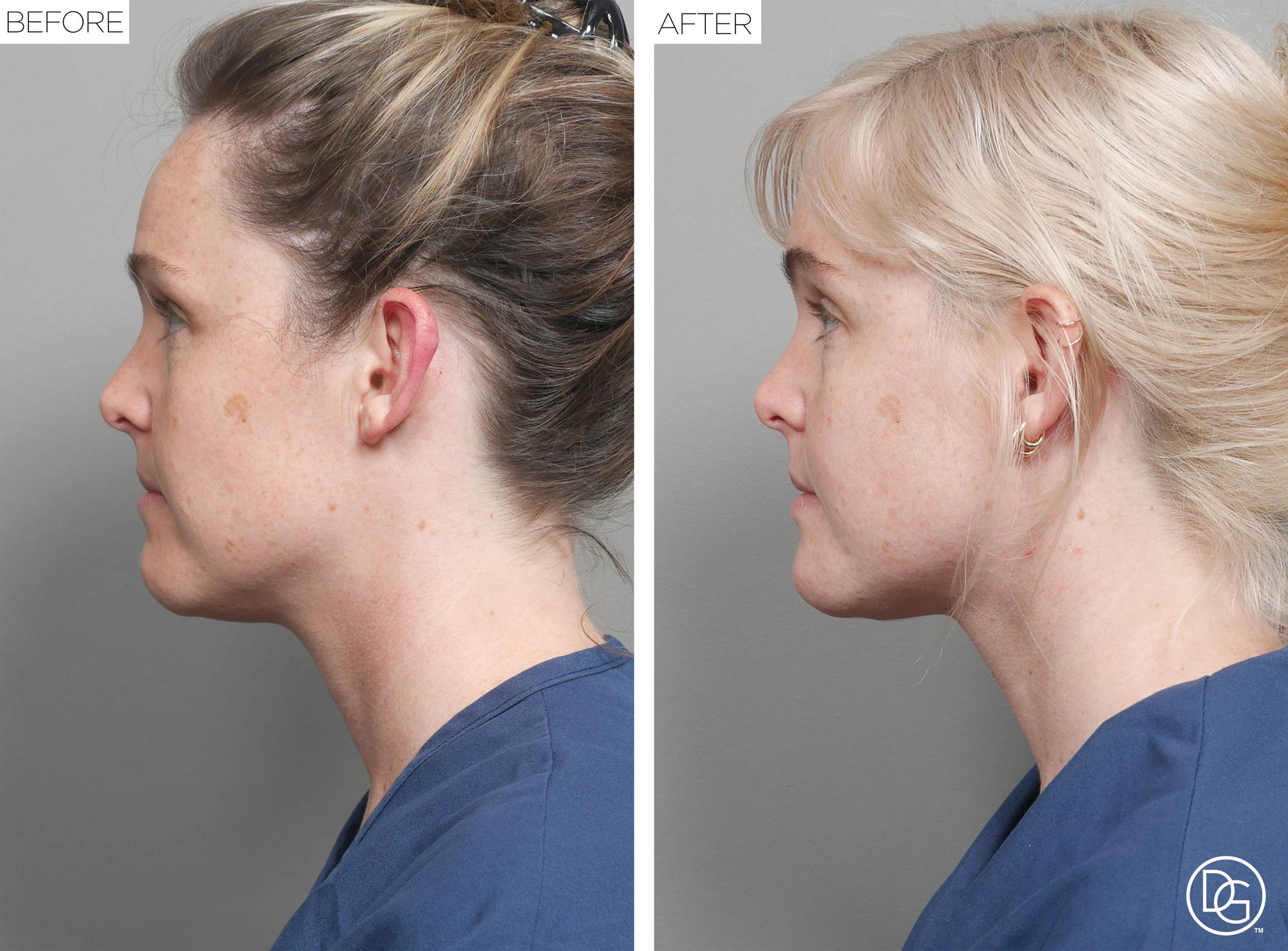 Weekend Lift Before & After Image