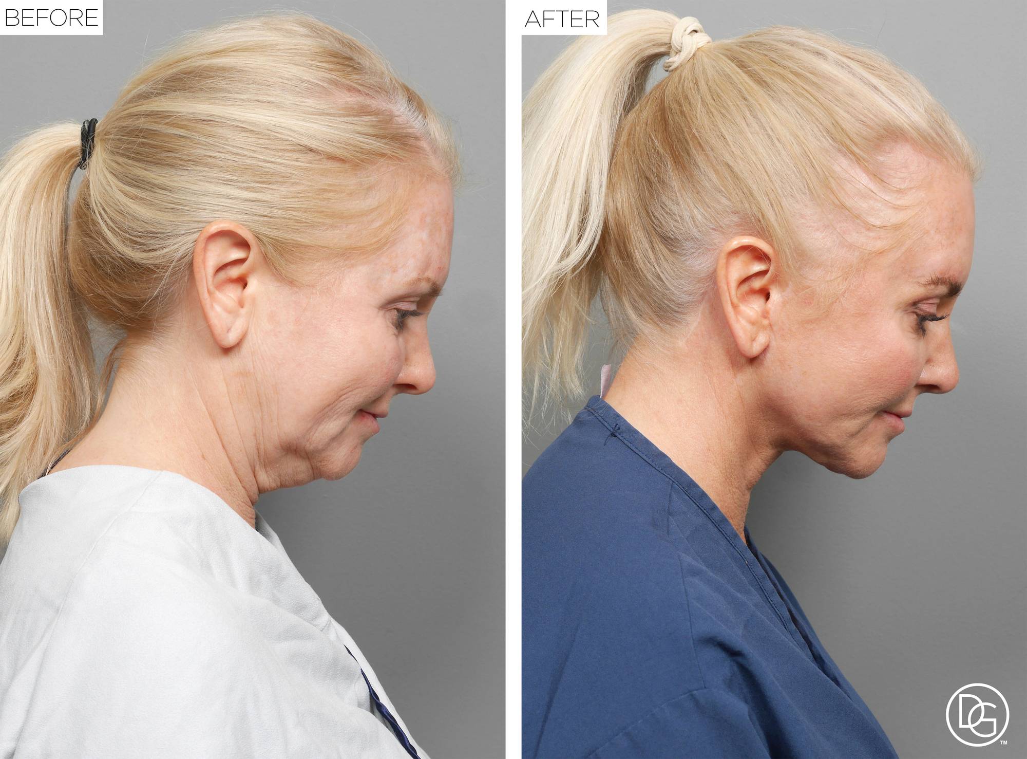 Facelift Before & After Image