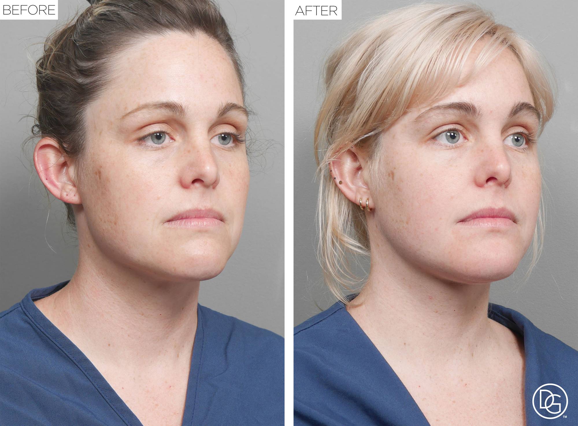 Weekend Lift Before & After Image