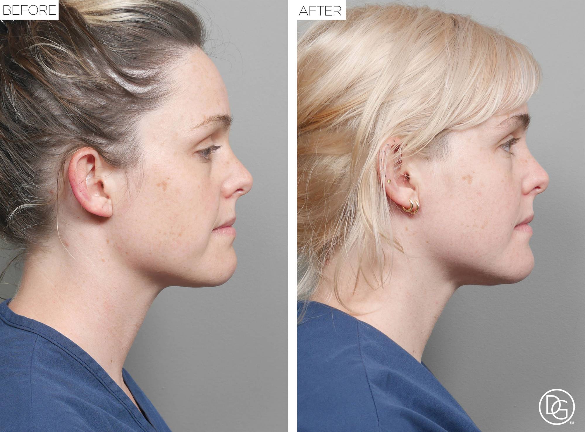 Weekend Lift Before & After Image