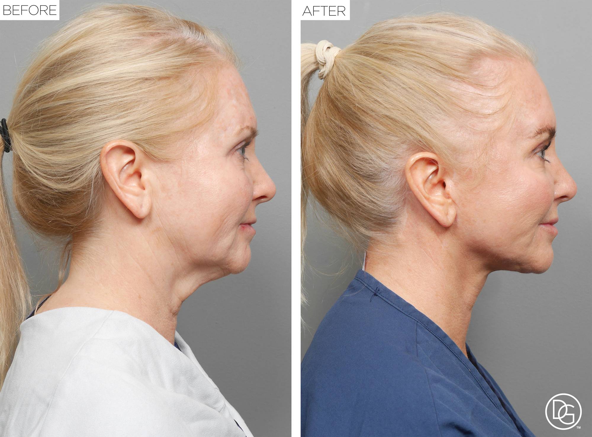 Facelift Before & After Image