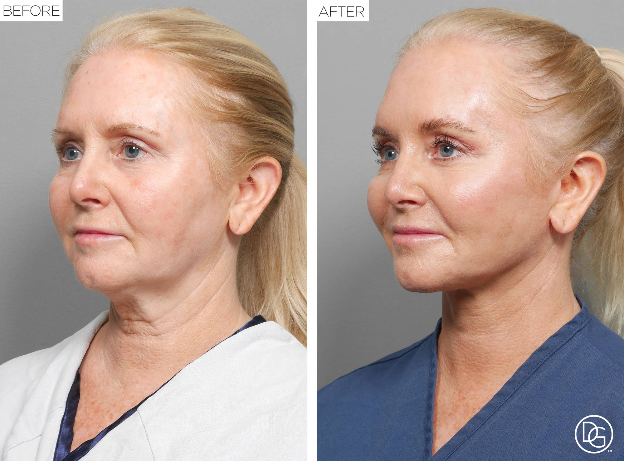 Facelift Before & After Image