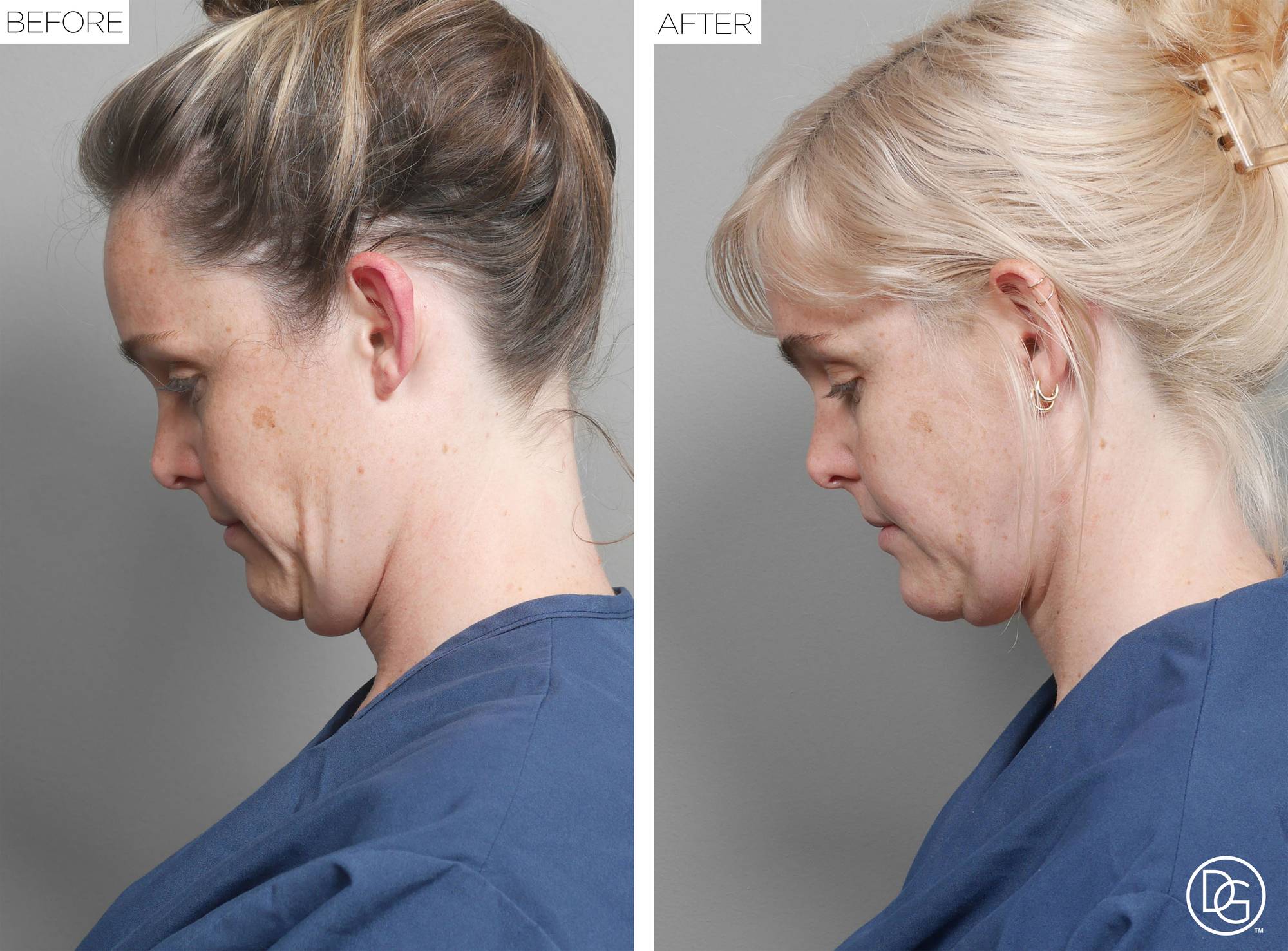 Weekend Lift Before & After Image