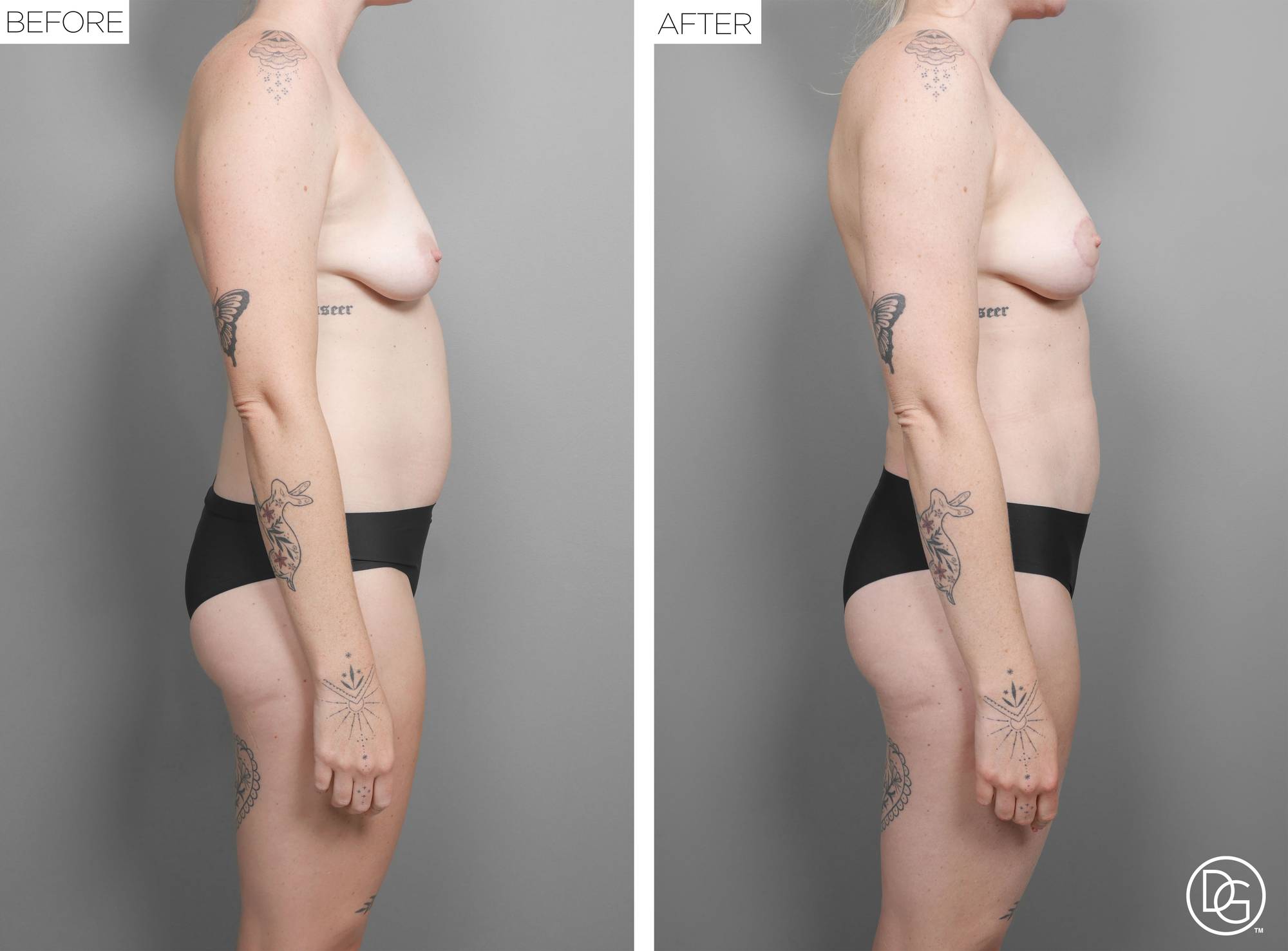 Liposuction Before & After Image