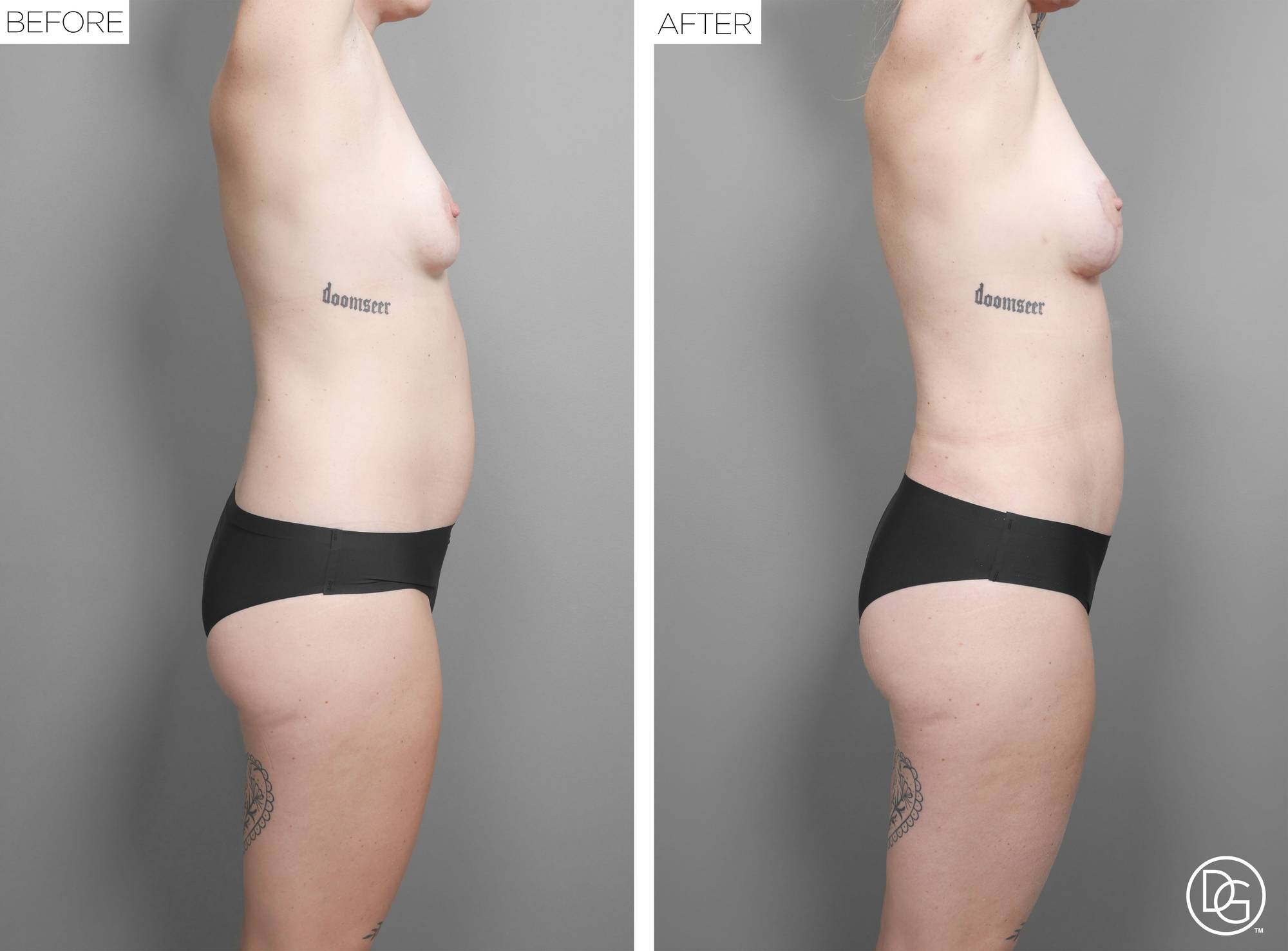 Liposuction Before & After Image