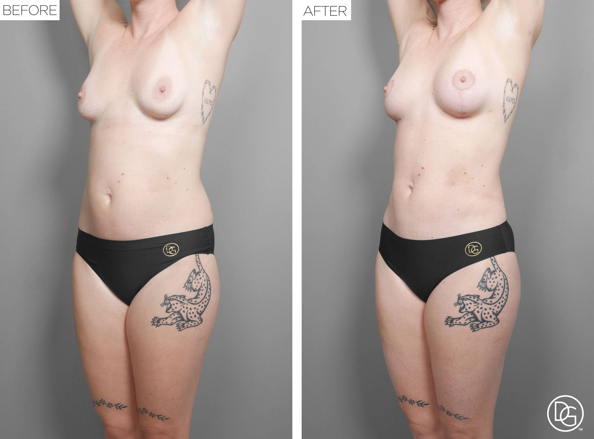 Liposuction Before & After Image