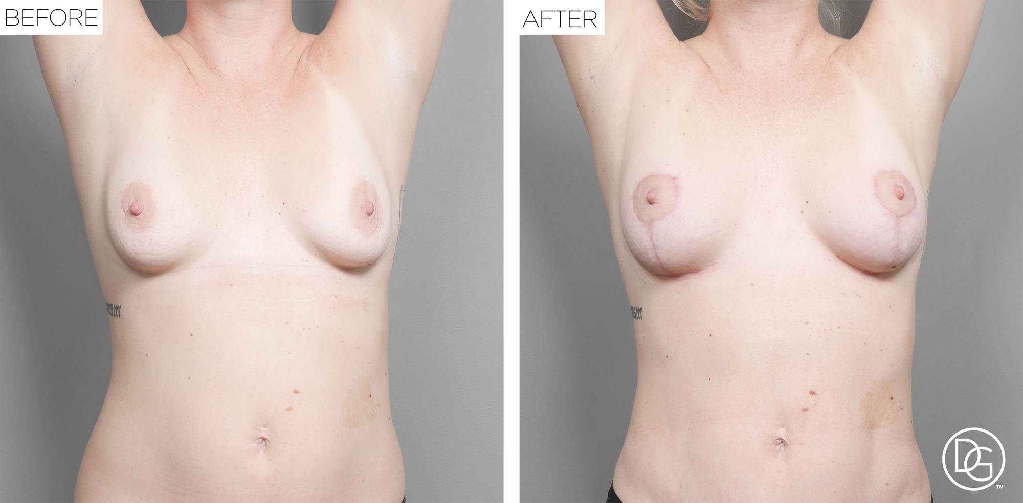 Breast Lift Before & After Image