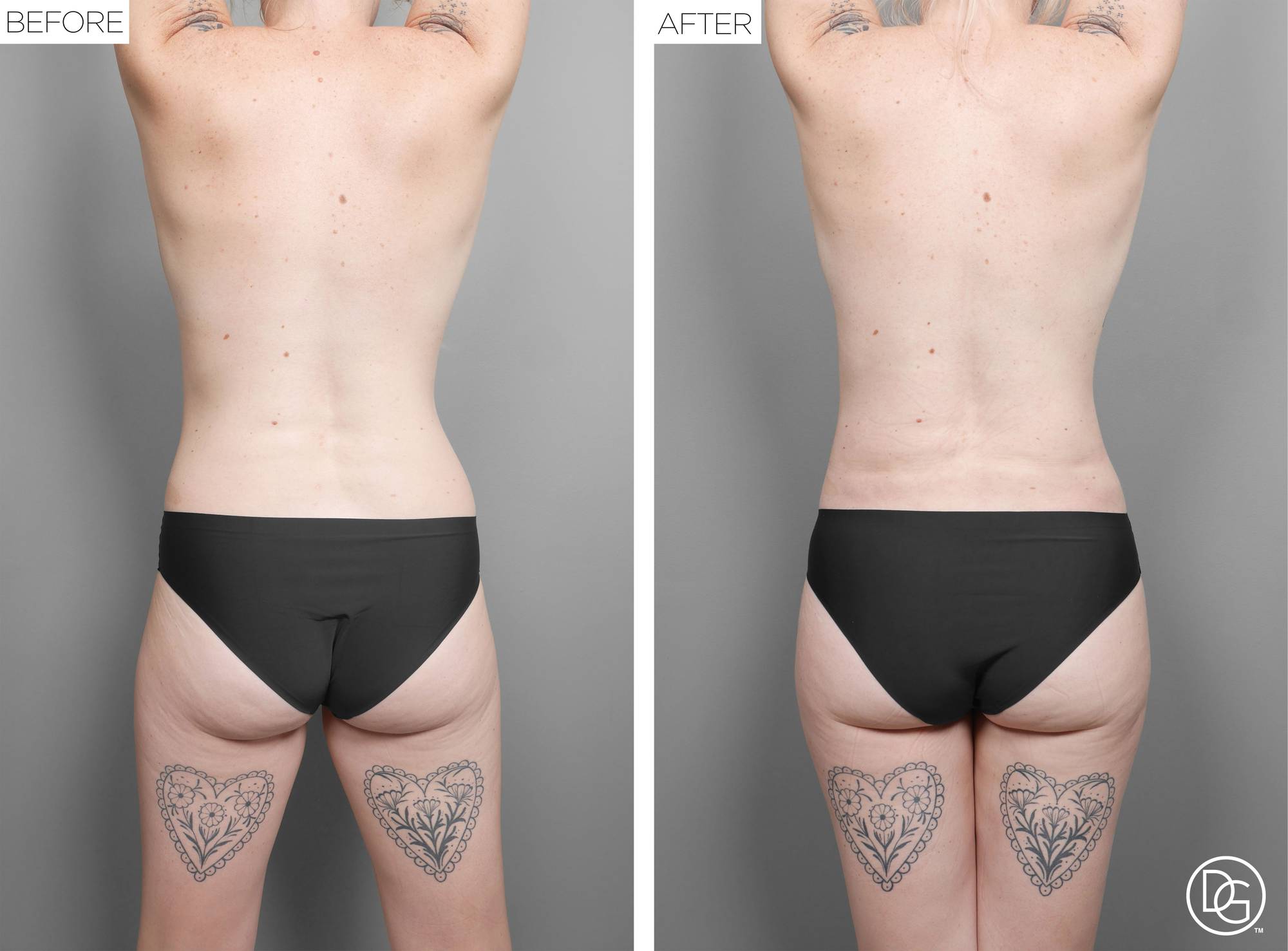Liposuction Before & After Image