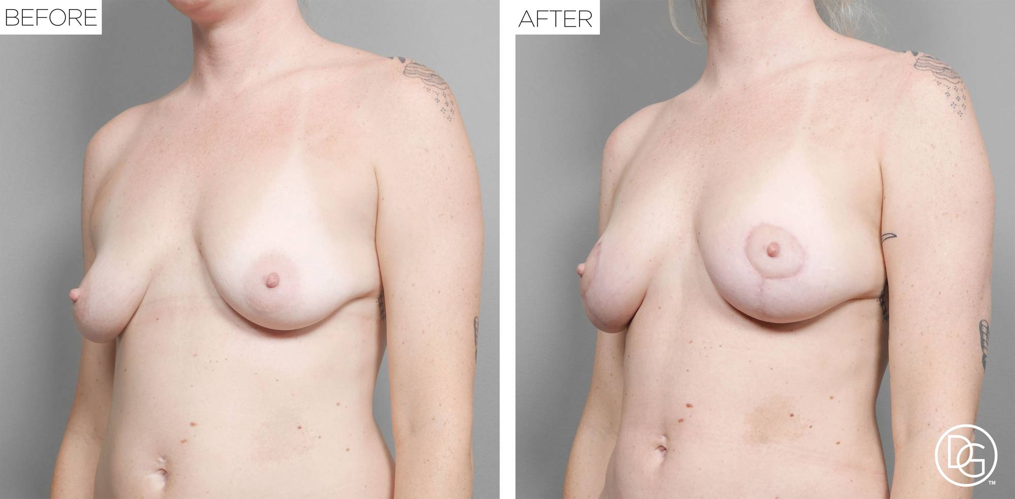 Breast Lift Before & After Image