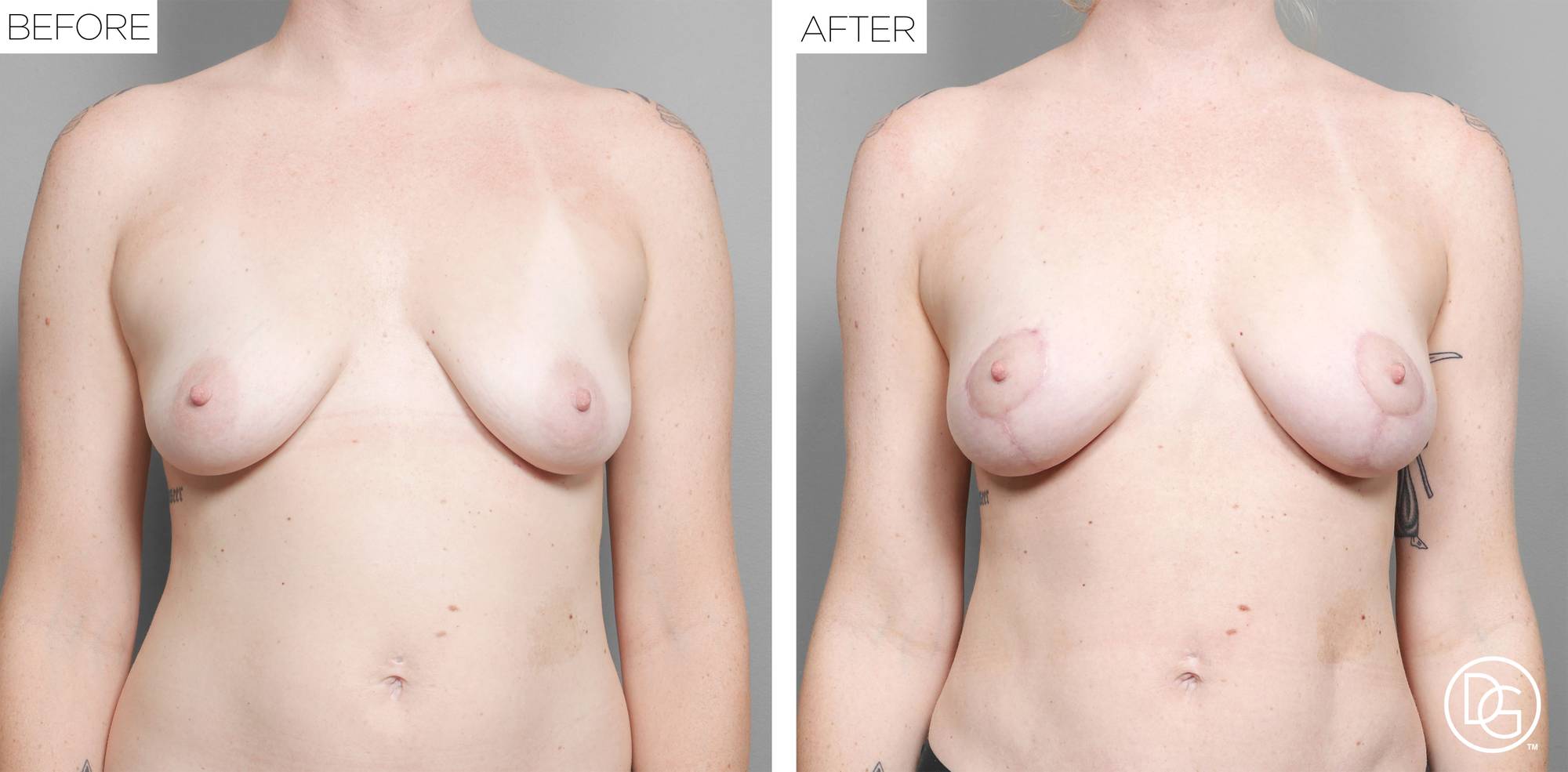 Breast Lift Before & After Image