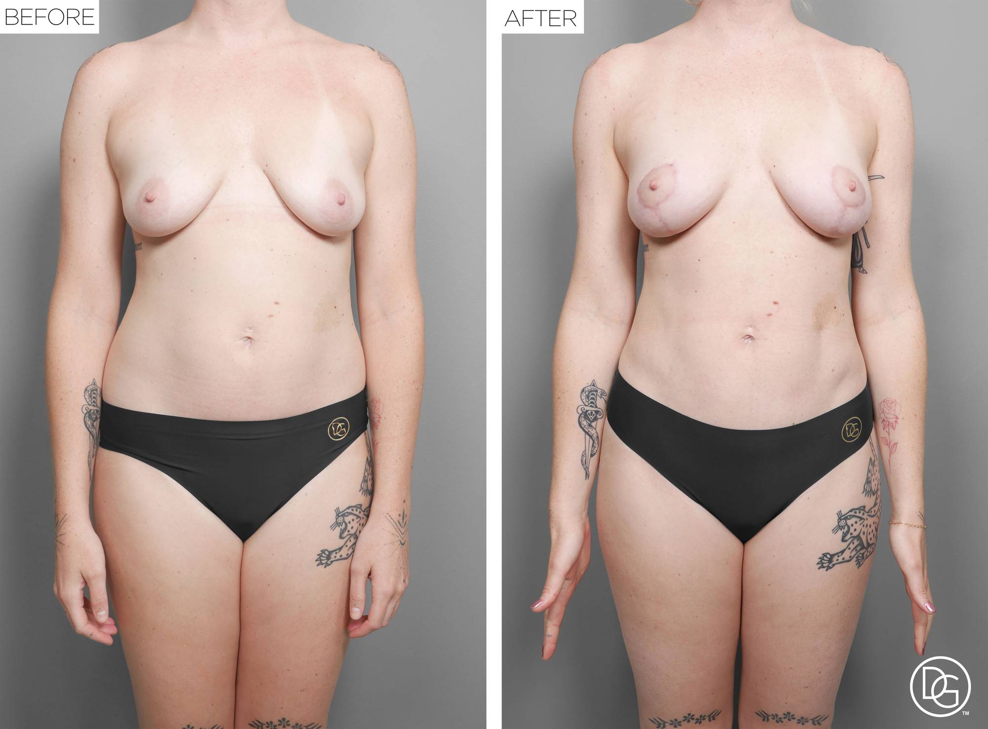Liposuction Before & After Image