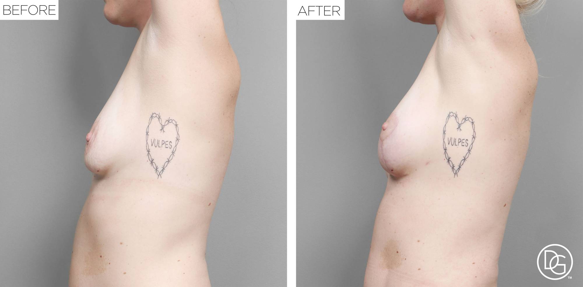 Breast Lift Before & After Image
