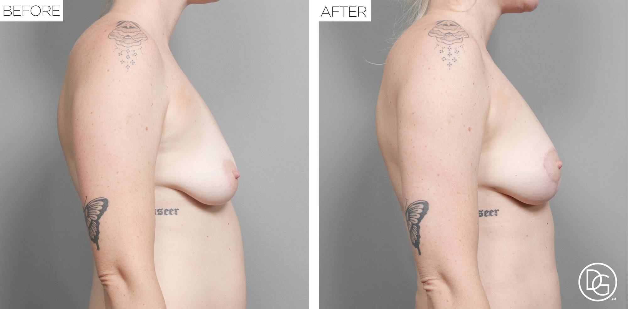 Breast Lift Before & After Image