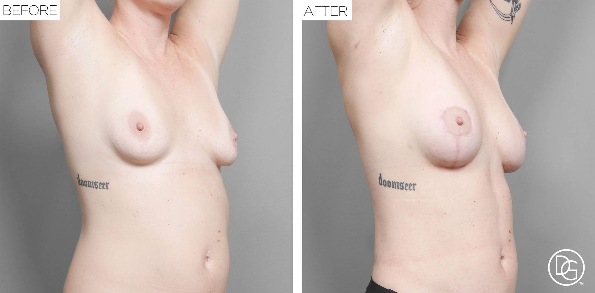 Breast Lift Before & After Image