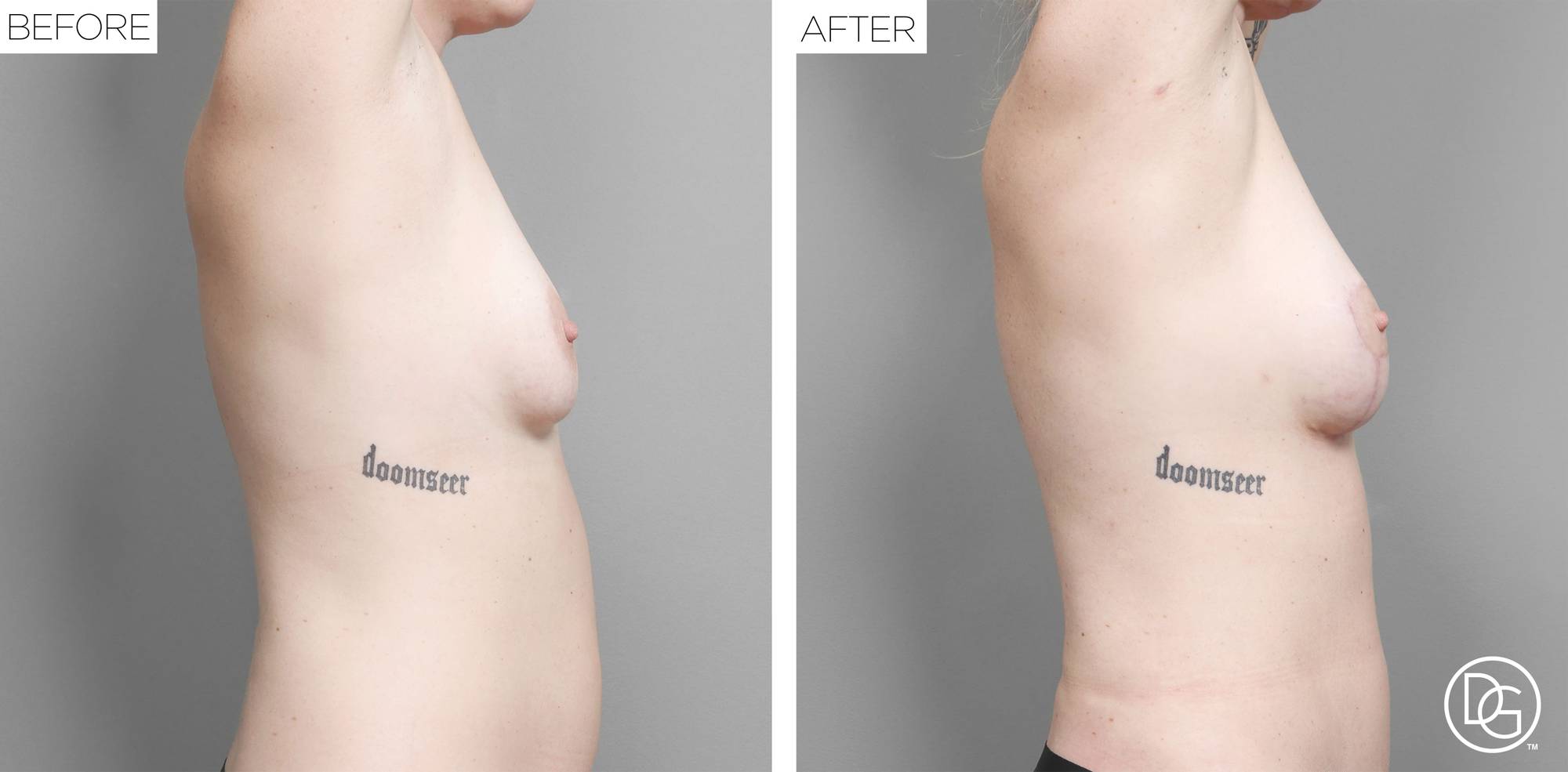 Breast Lift Before & After Image