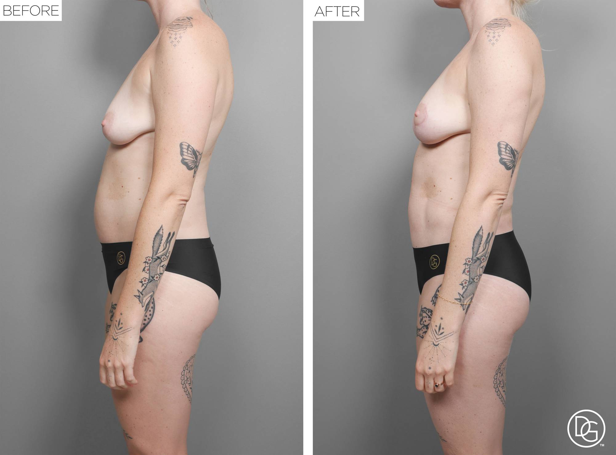 Liposuction Before & After Image