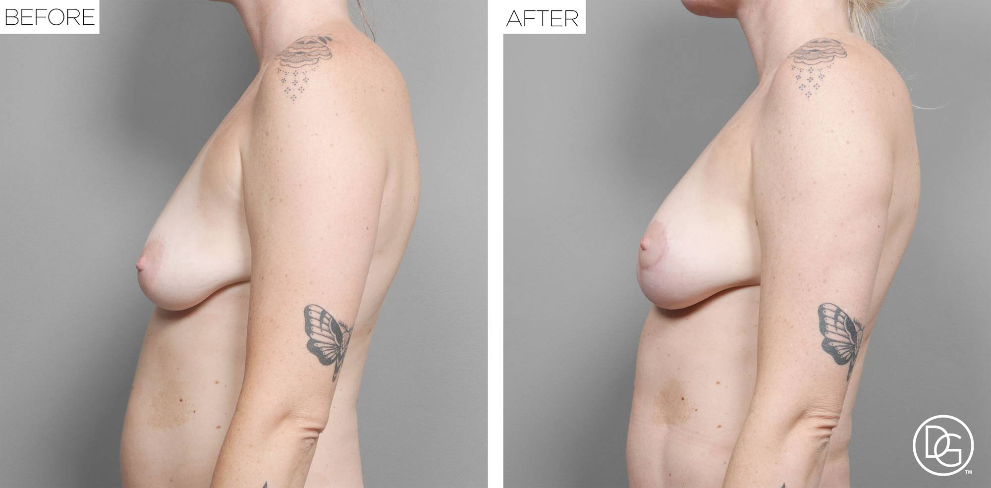 Breast Lift Before & After Image