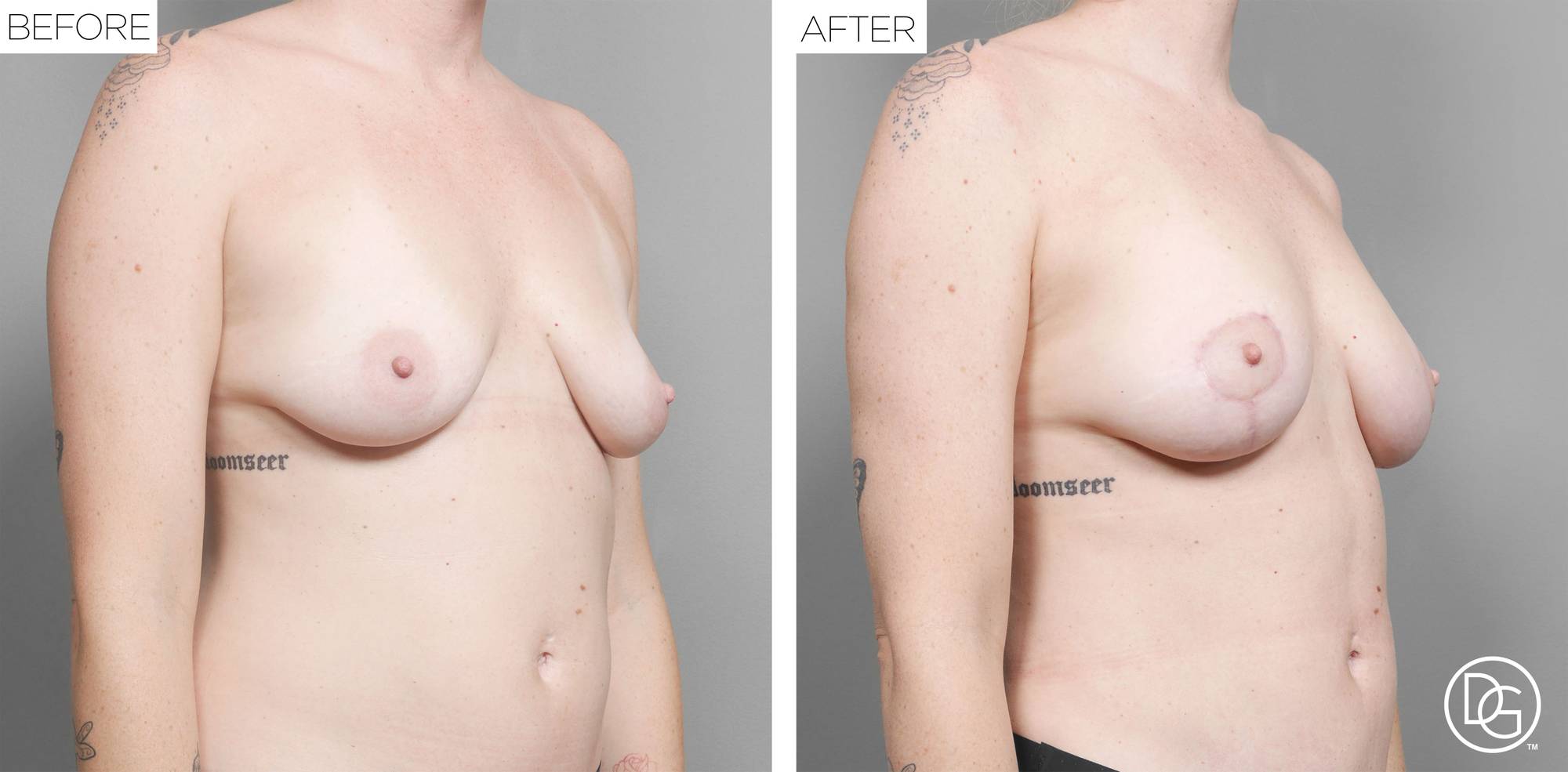 Breast Lift Before & After Image