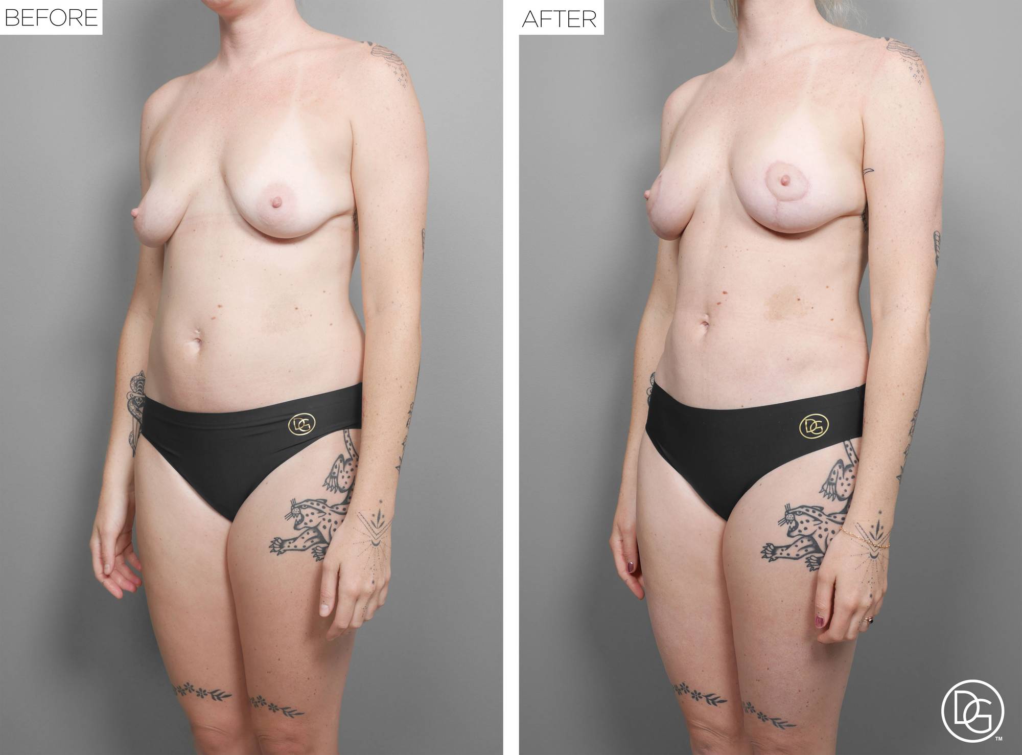 Liposuction Before & After Image