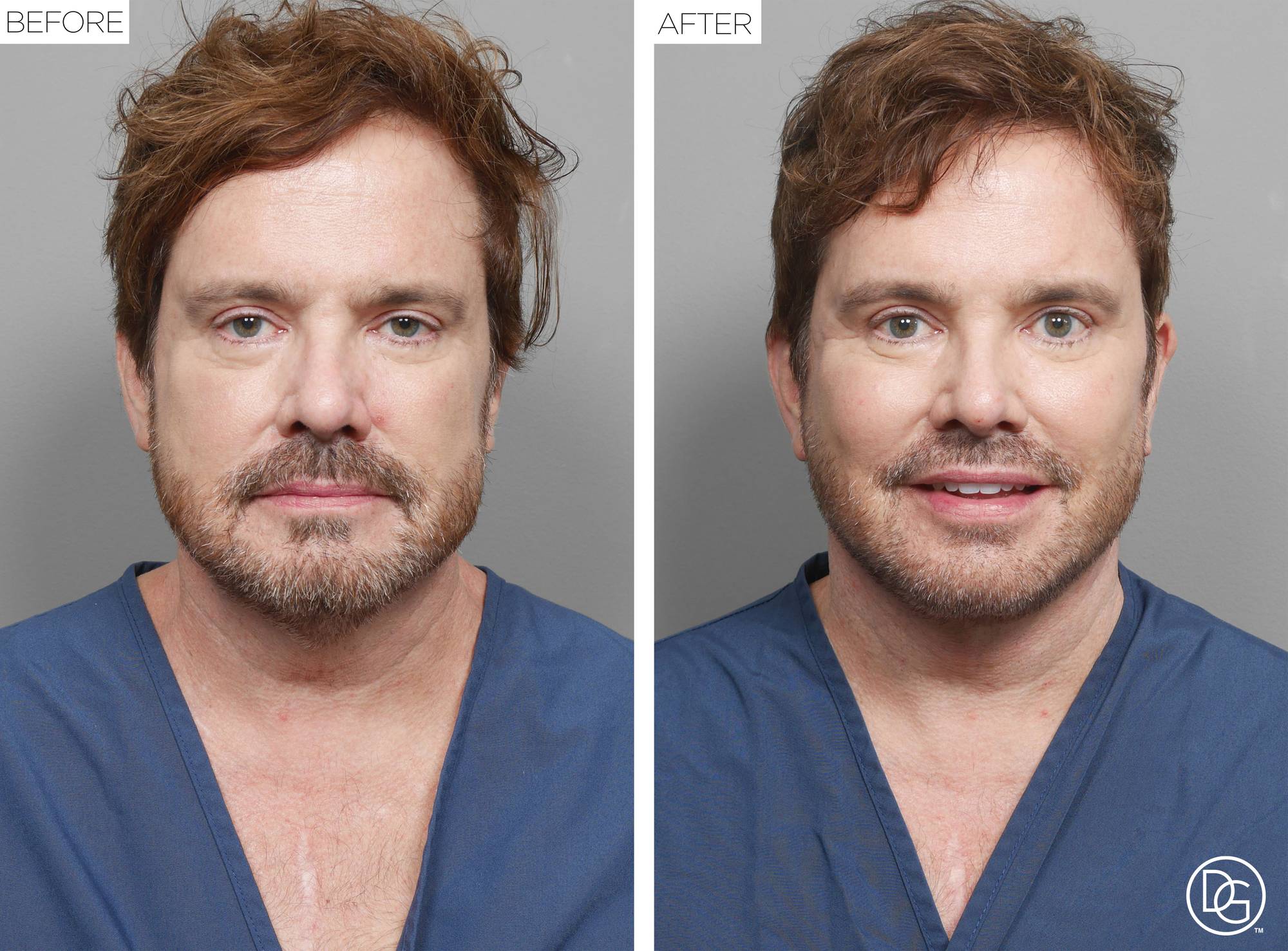 Facelift Before & After Image