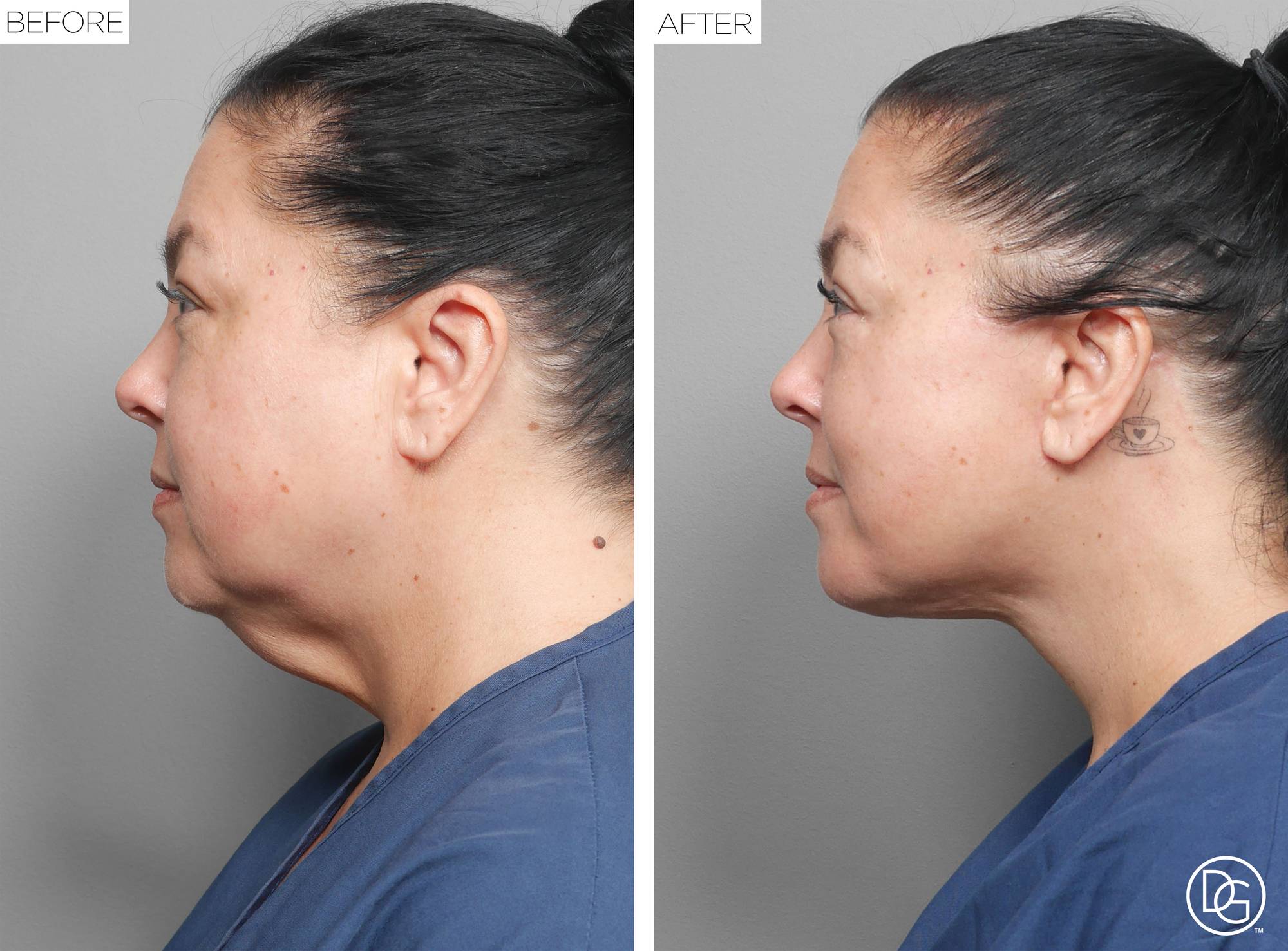 Facelift Before & After Image