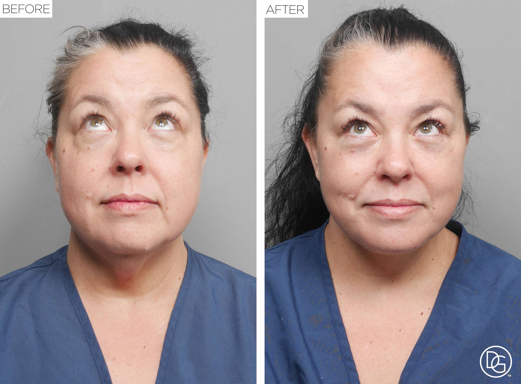 Facelift Before & After Image