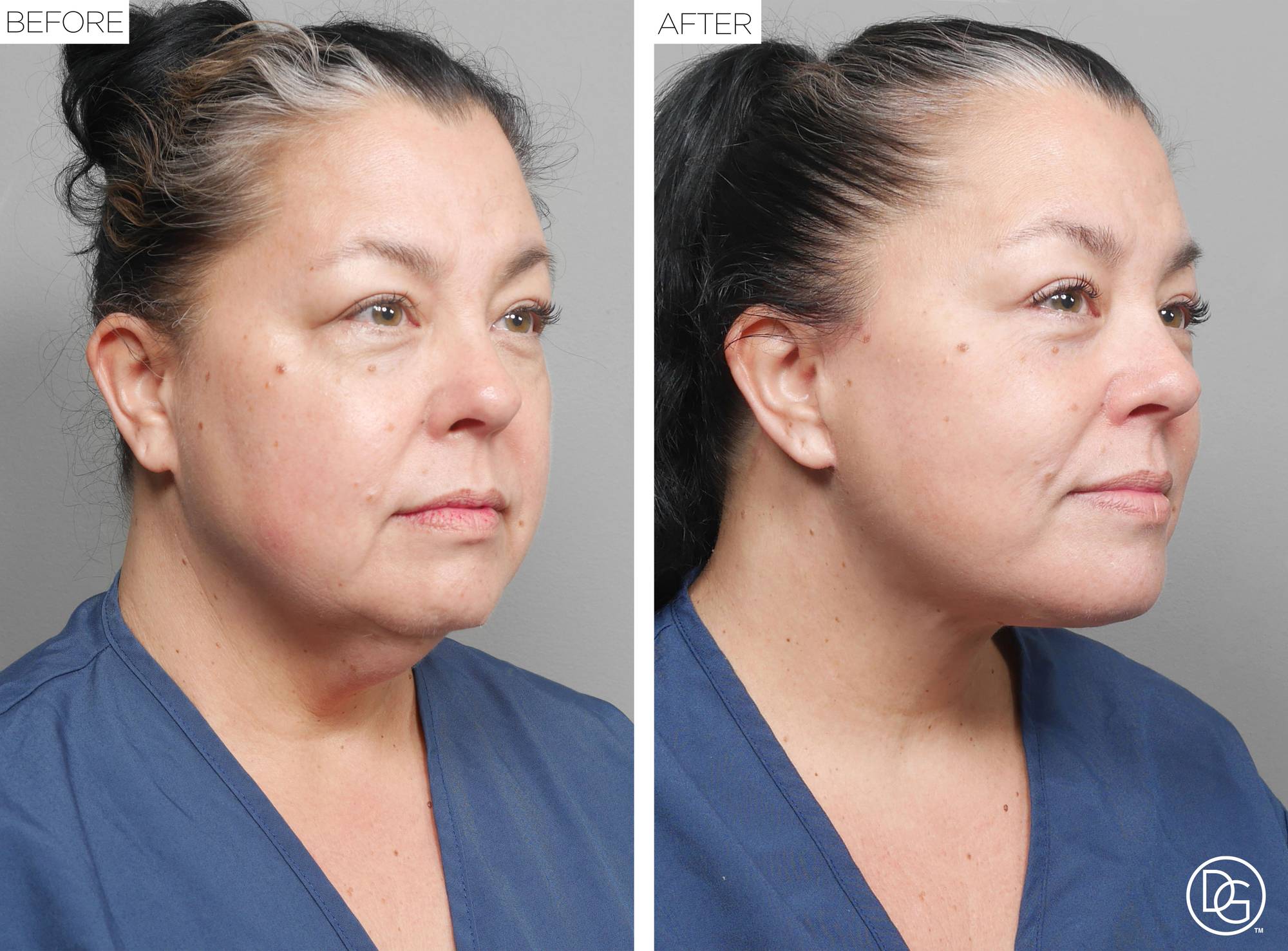 Facelift Before & After Image