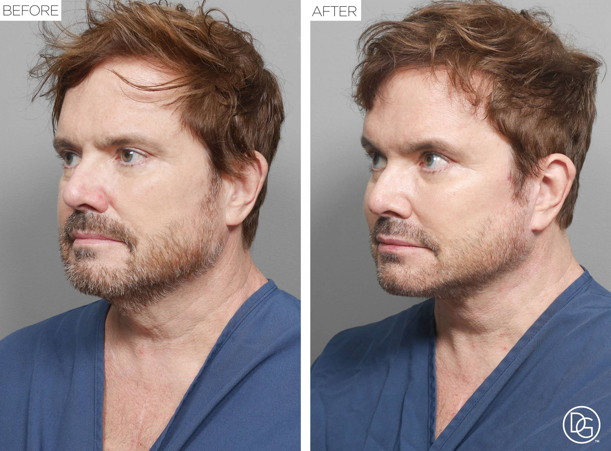 Facelift Before & After Image