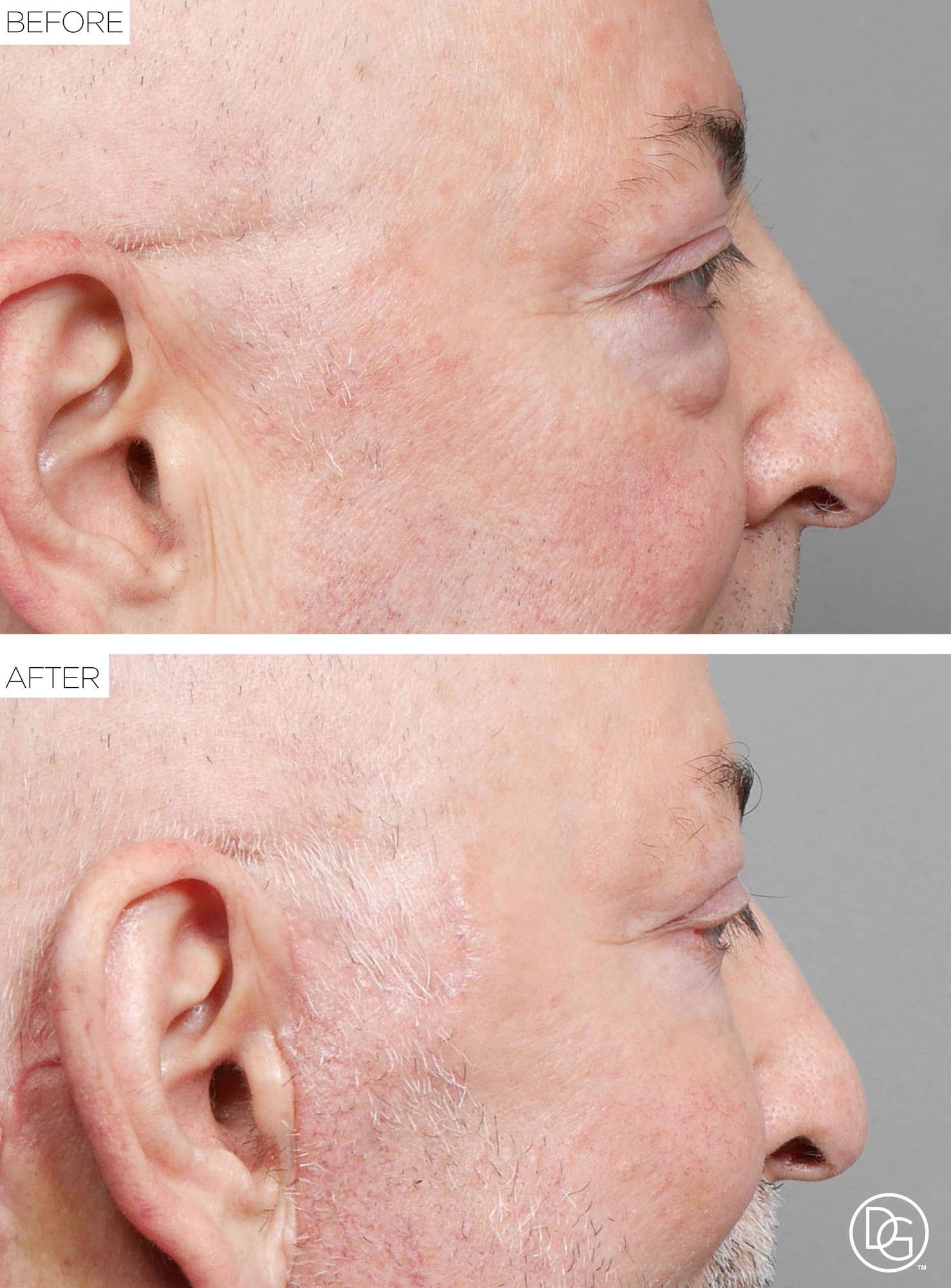 Blepharoplasty Before & After Image