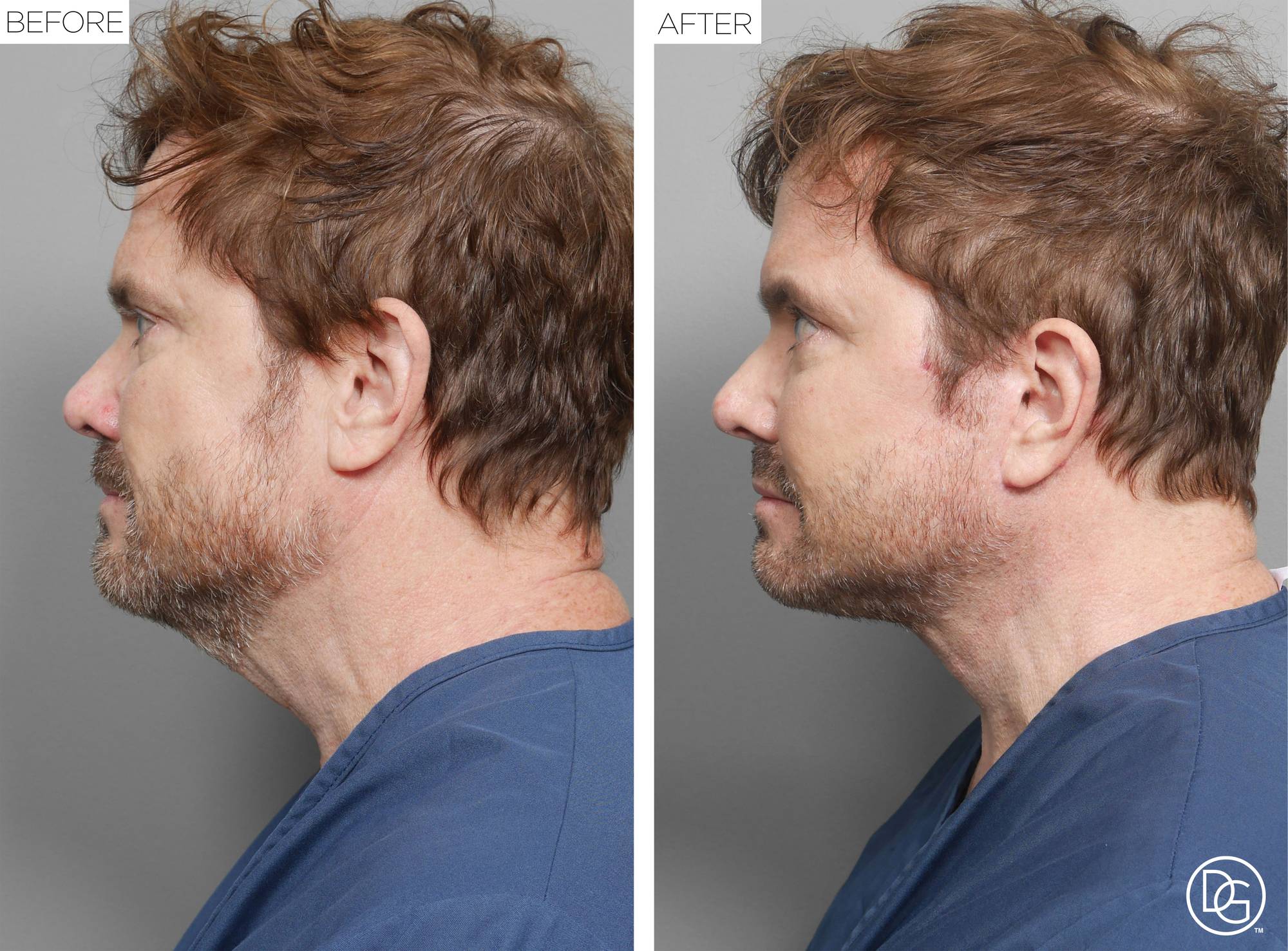 Facelift Before & After Image