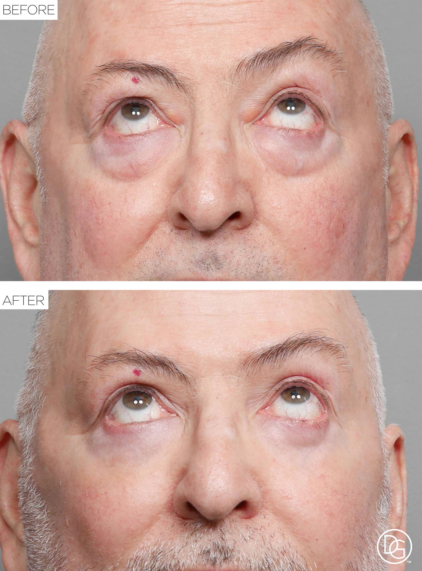 Blepharoplasty Before & After Image