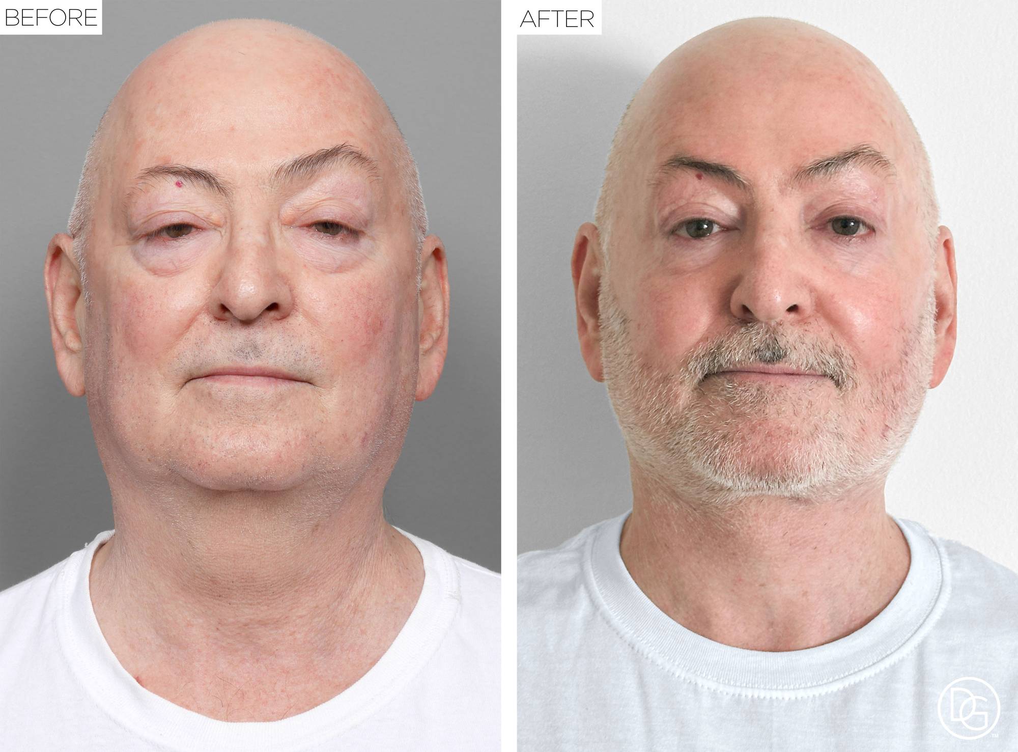 Facelift Before & After Image