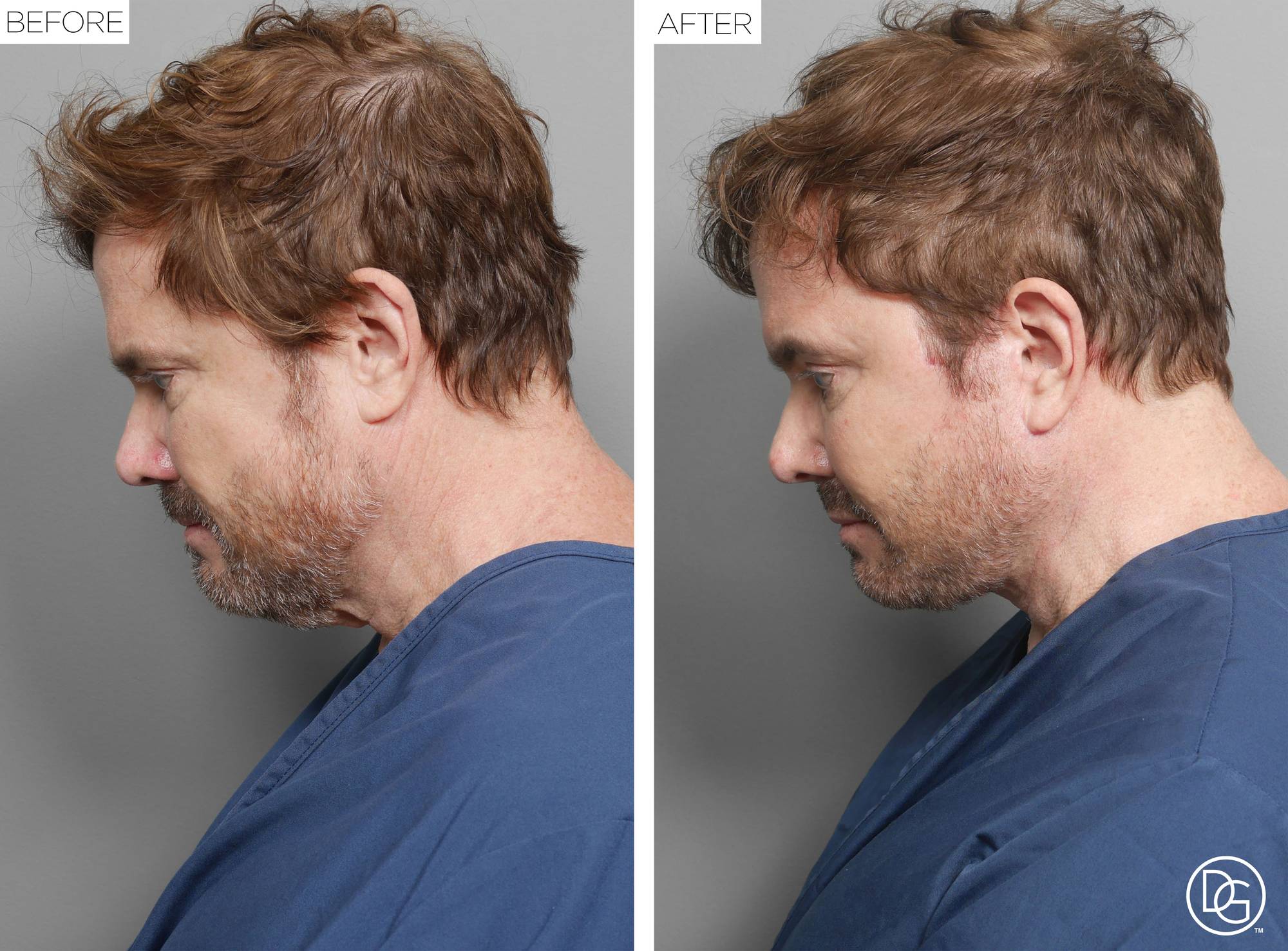 Facelift Before & After Image
