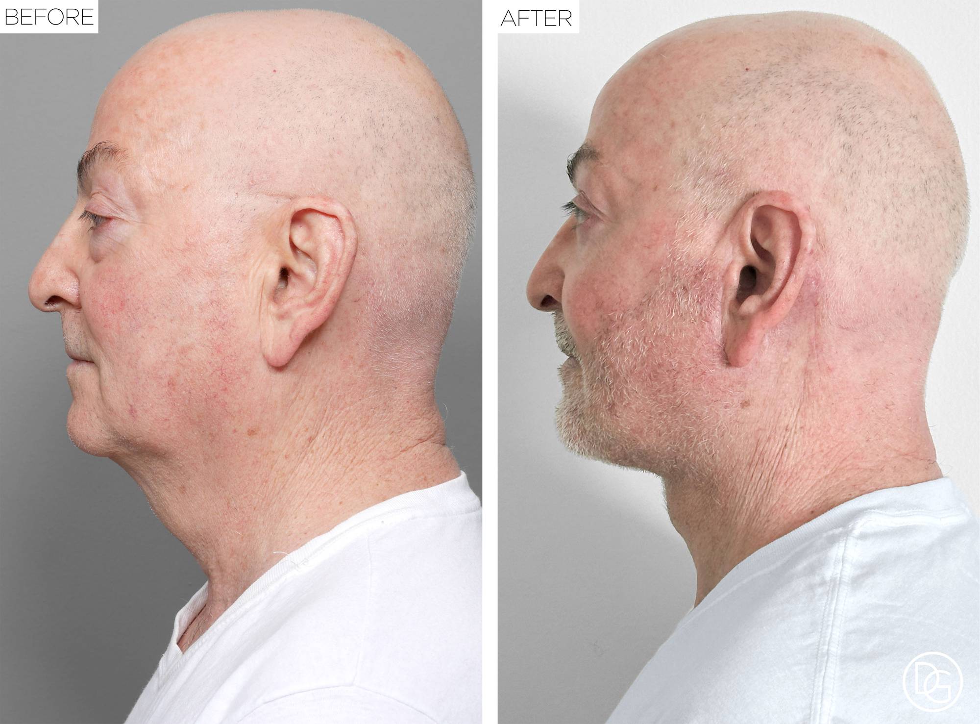 Facelift Before & After Image