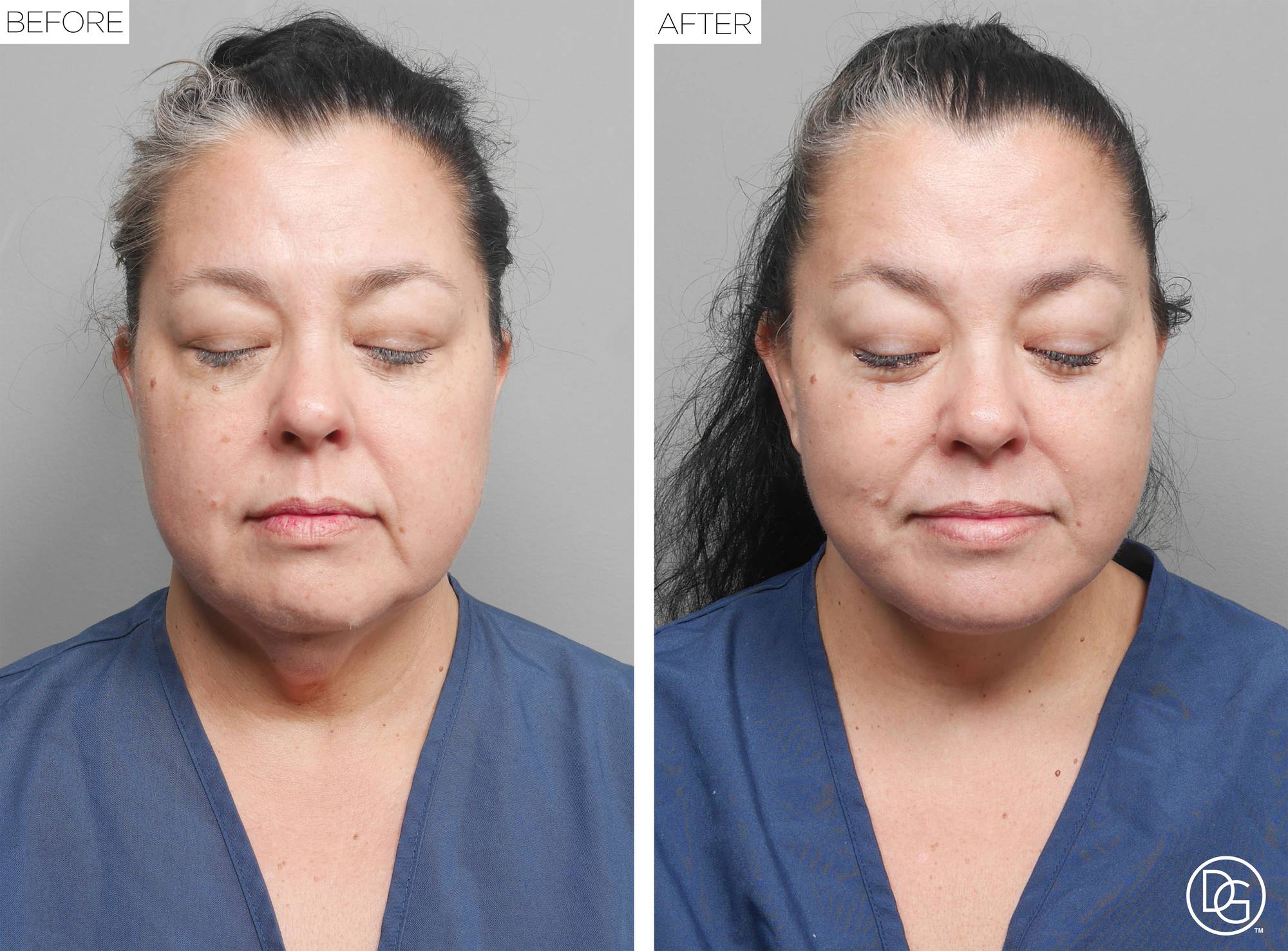Facelift Before & After Image