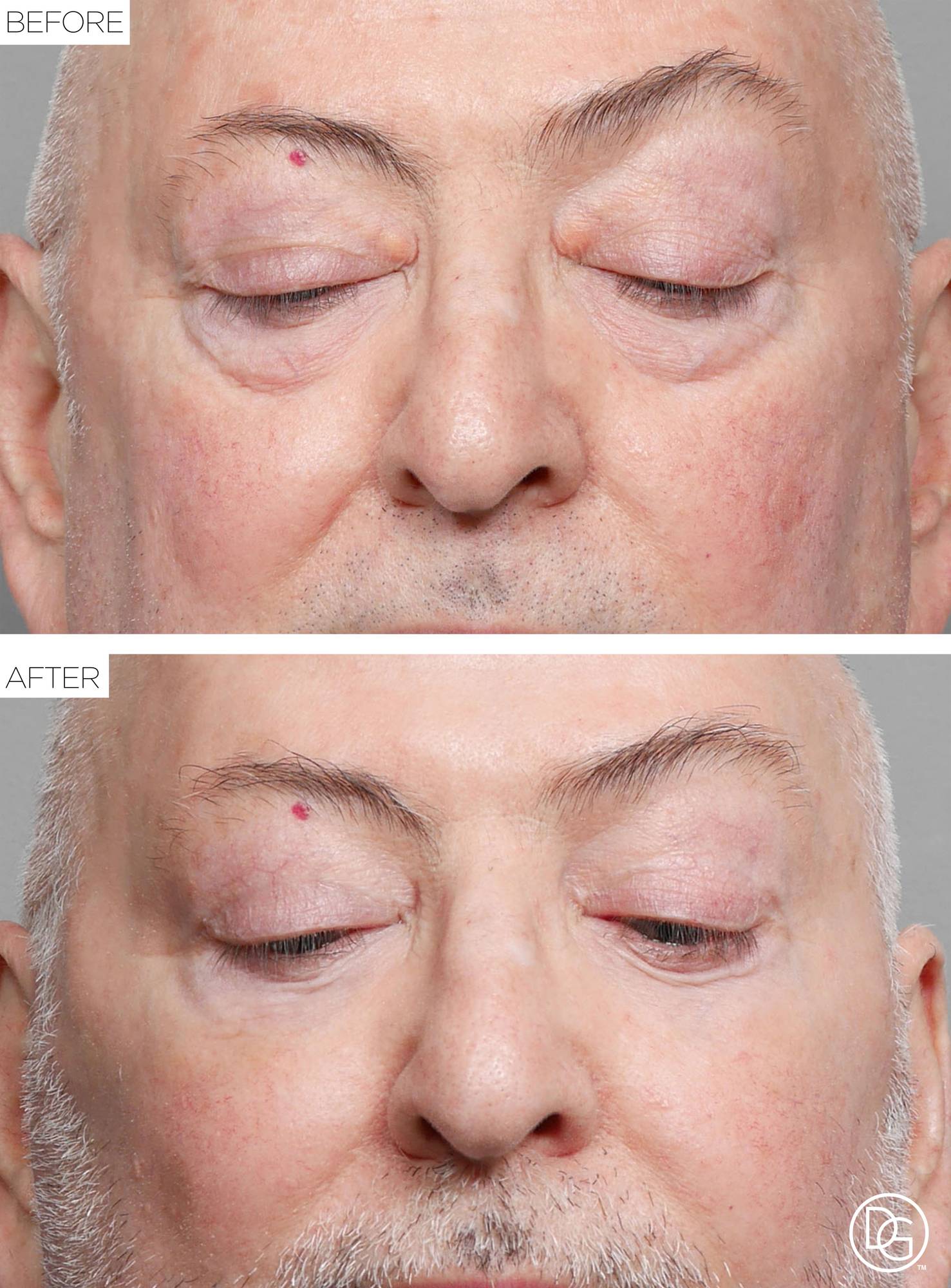 Blepharoplasty Before & After Image