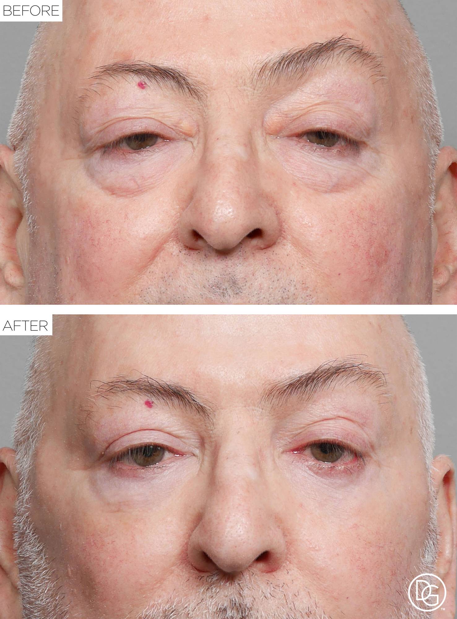 Blepharoplasty Before & After Image
