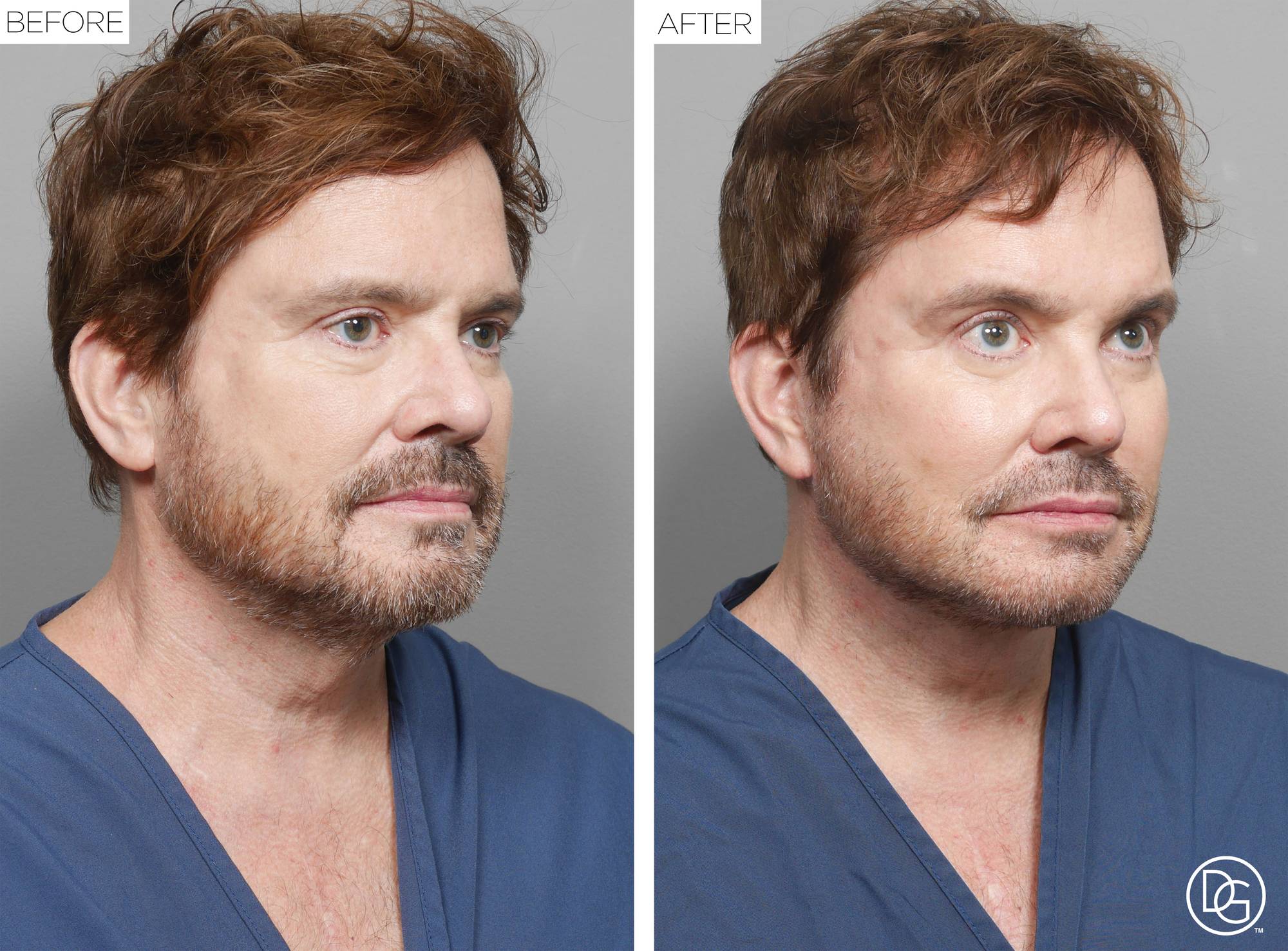 Facelift Before & After Image