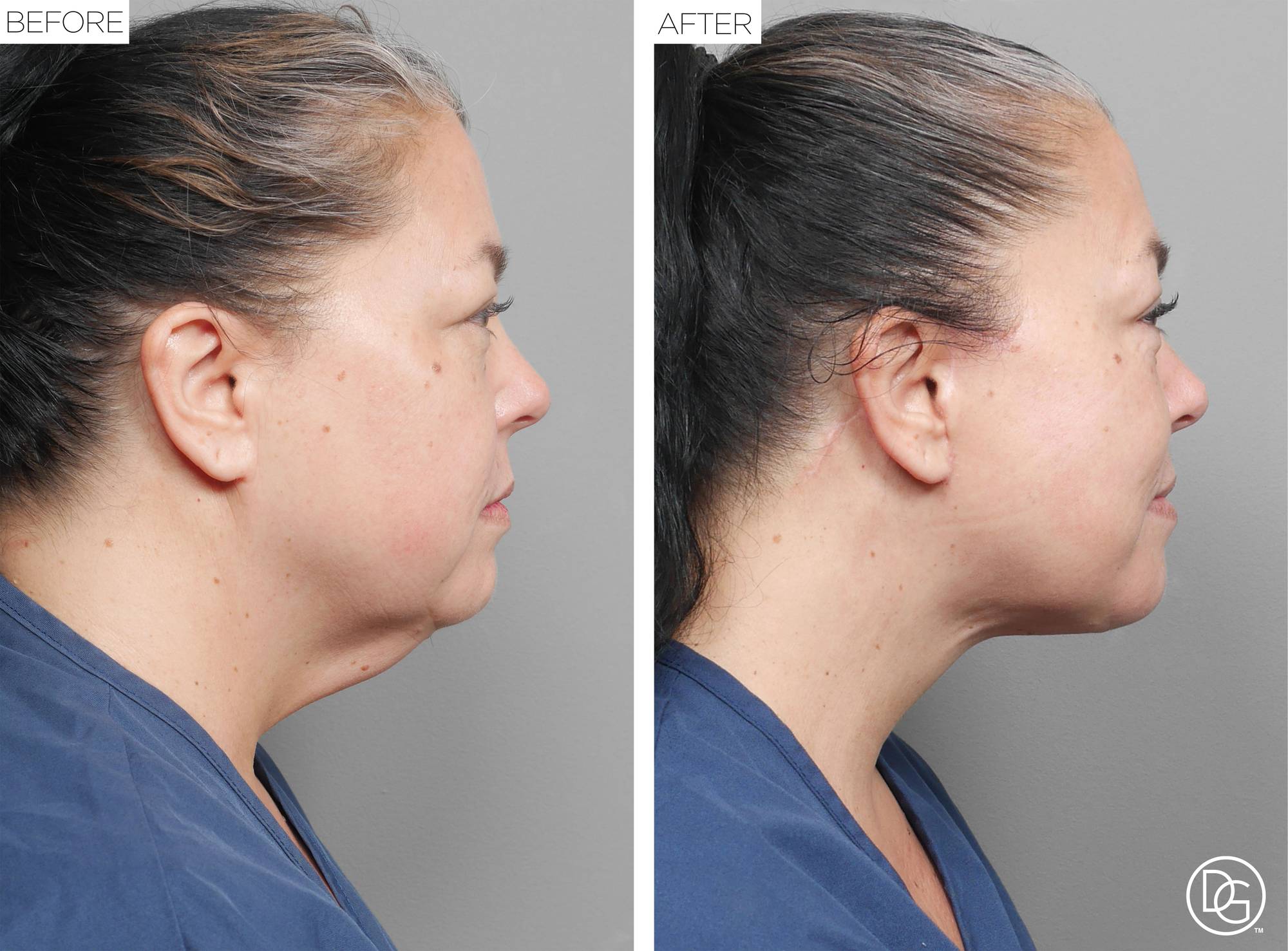 Facelift Before & After Image