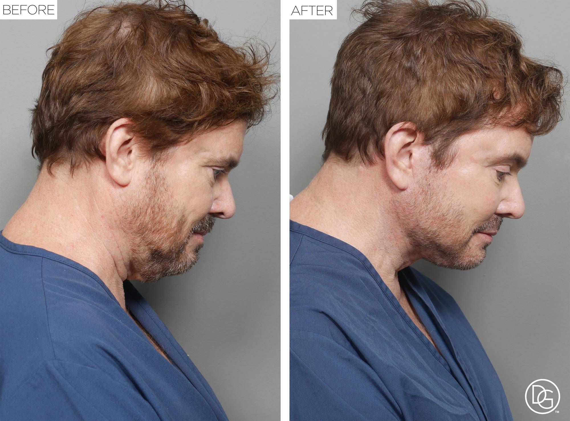 Facelift Before & After Image