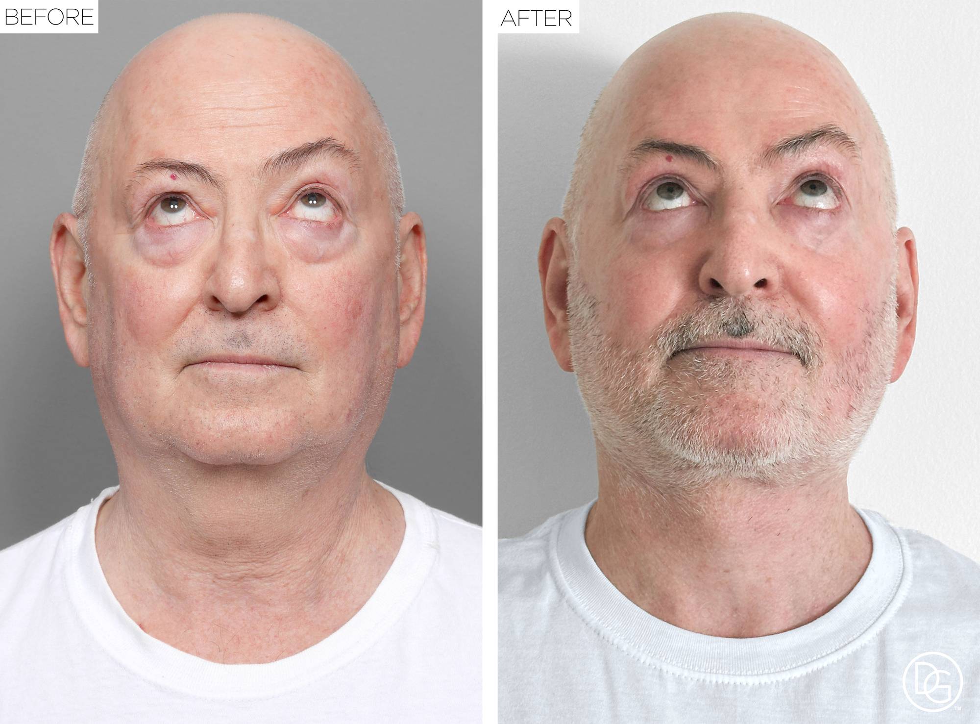 Facelift Before & After Image
