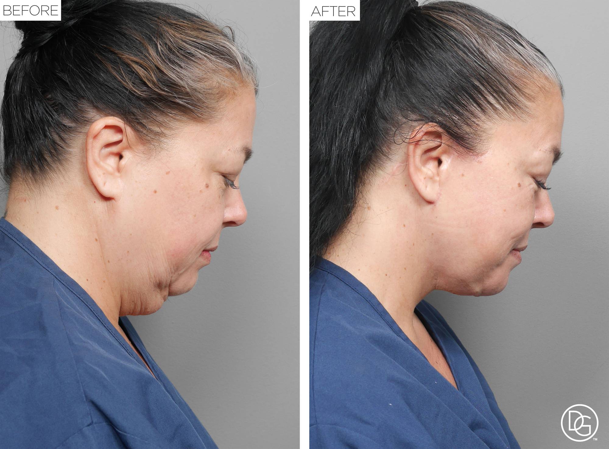 Facelift Before & After Image