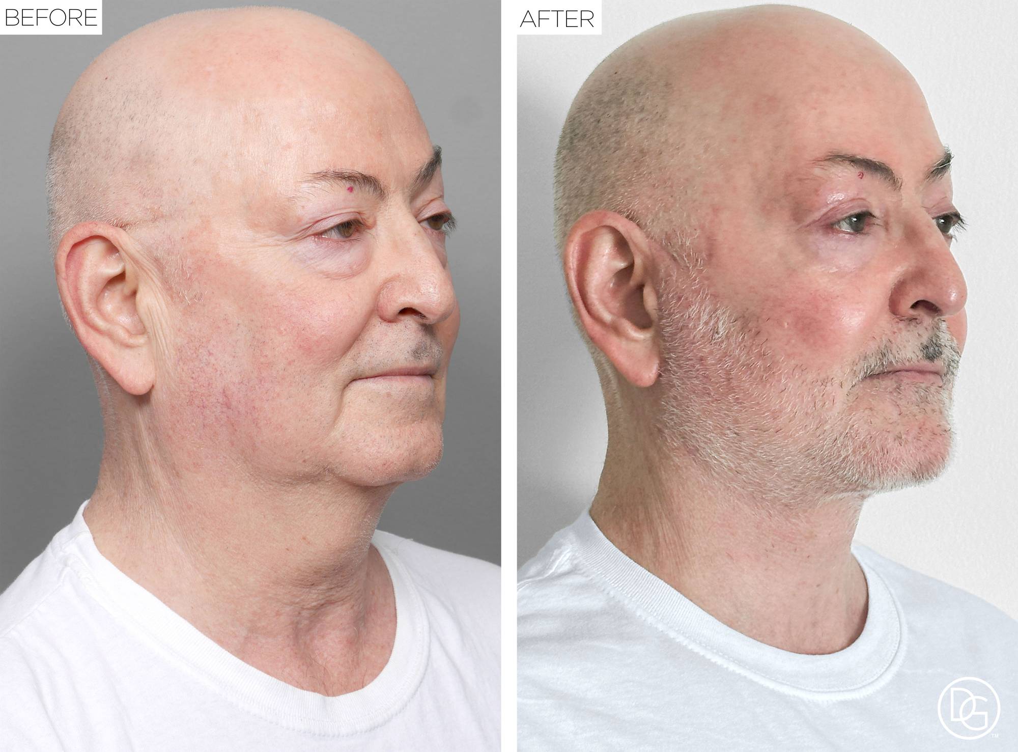 Facelift Before & After Image