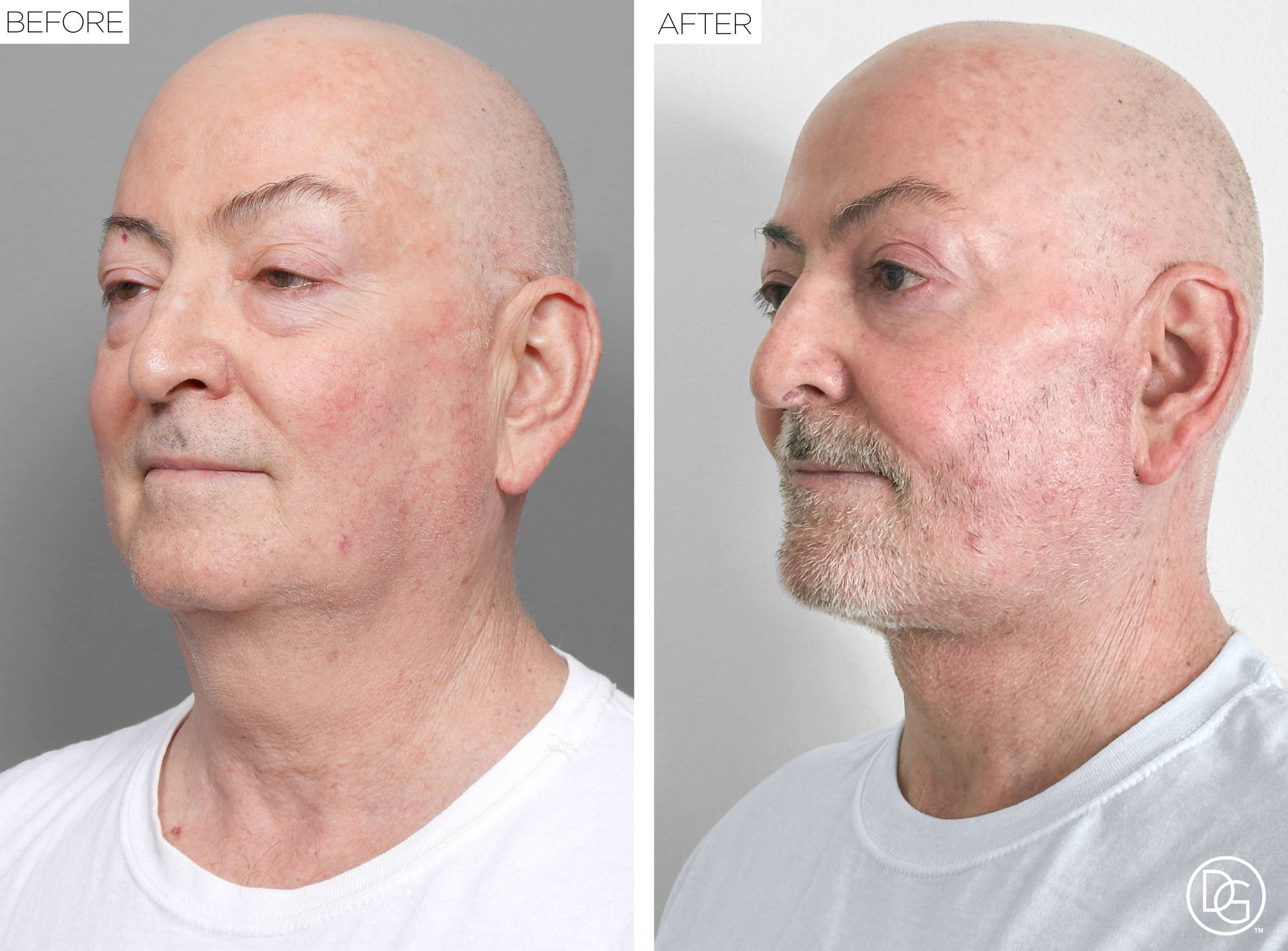 Facelift Before & After Image
