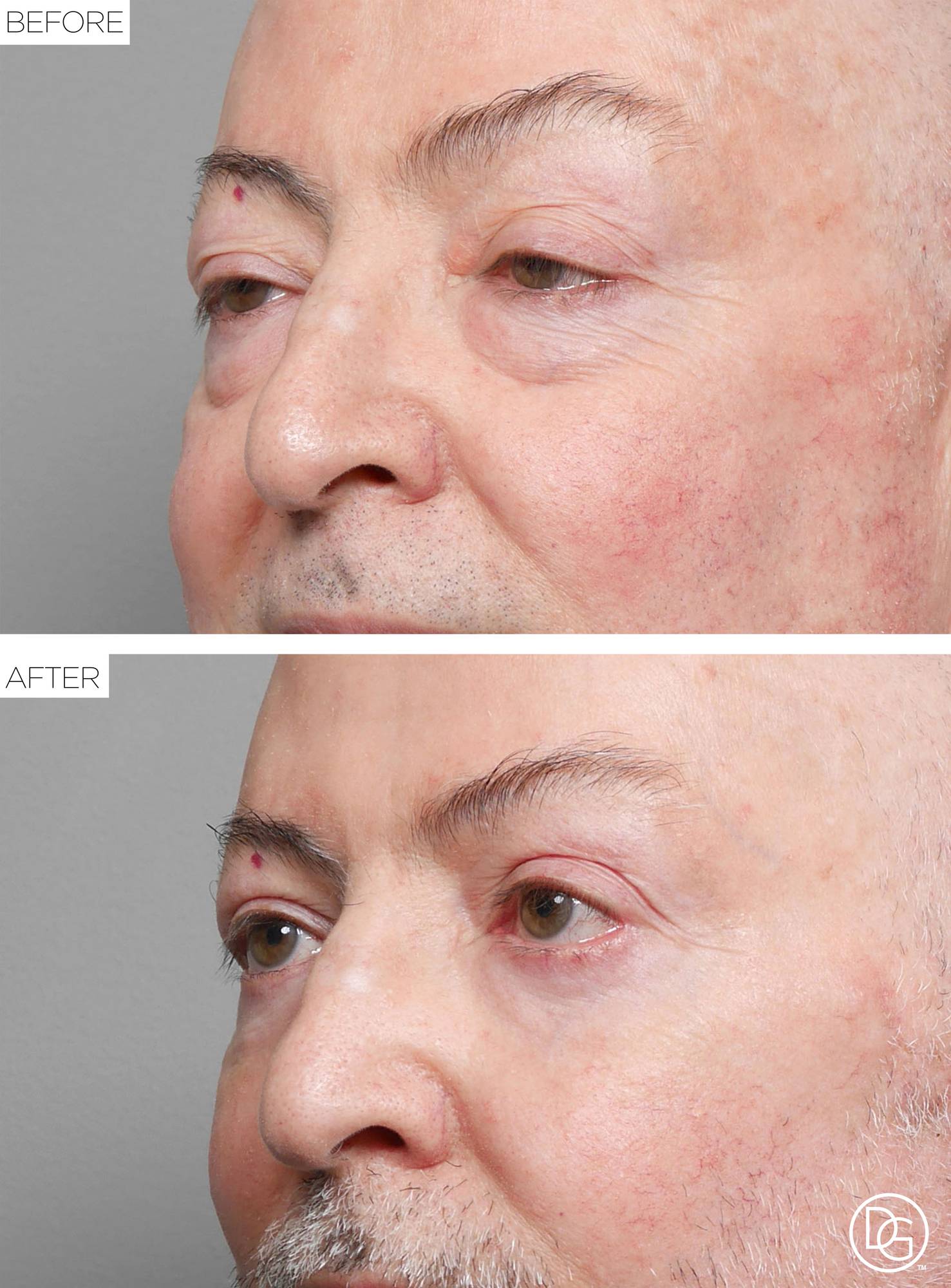 Blepharoplasty Before & After Image