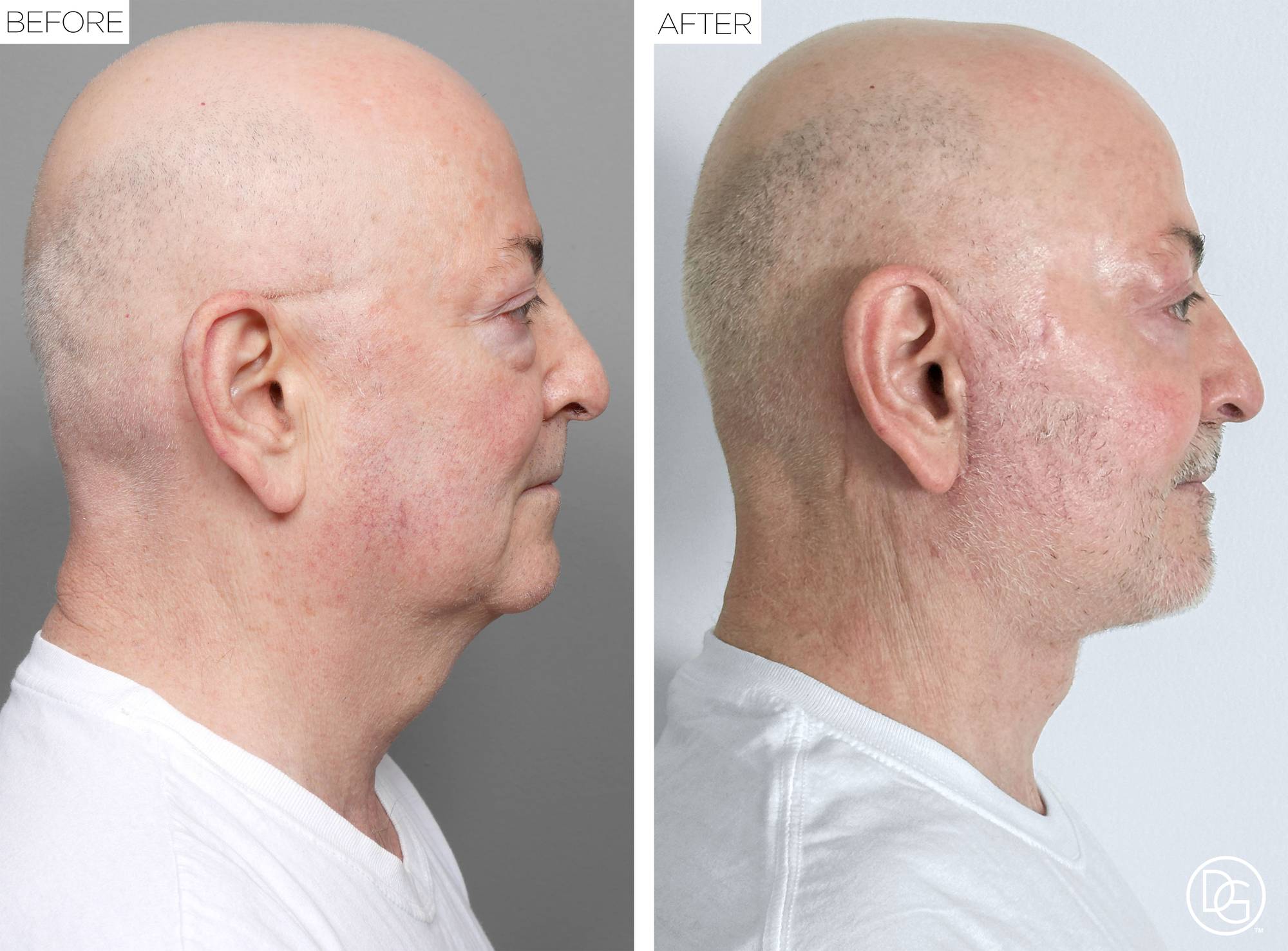 Facelift Before & After Image