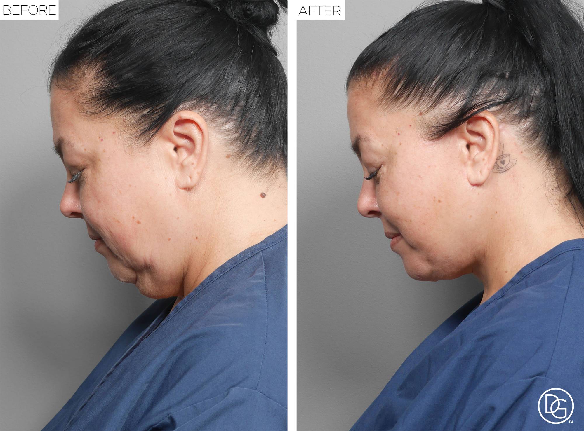 Facelift Before & After Image