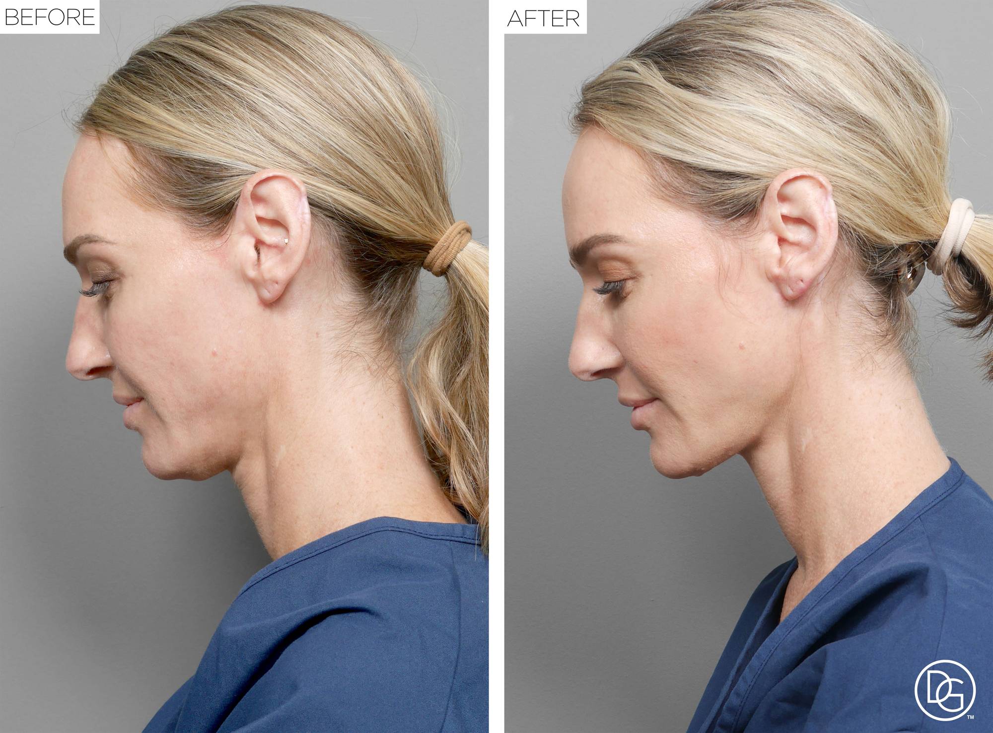 Weekend Lift Before & After Image