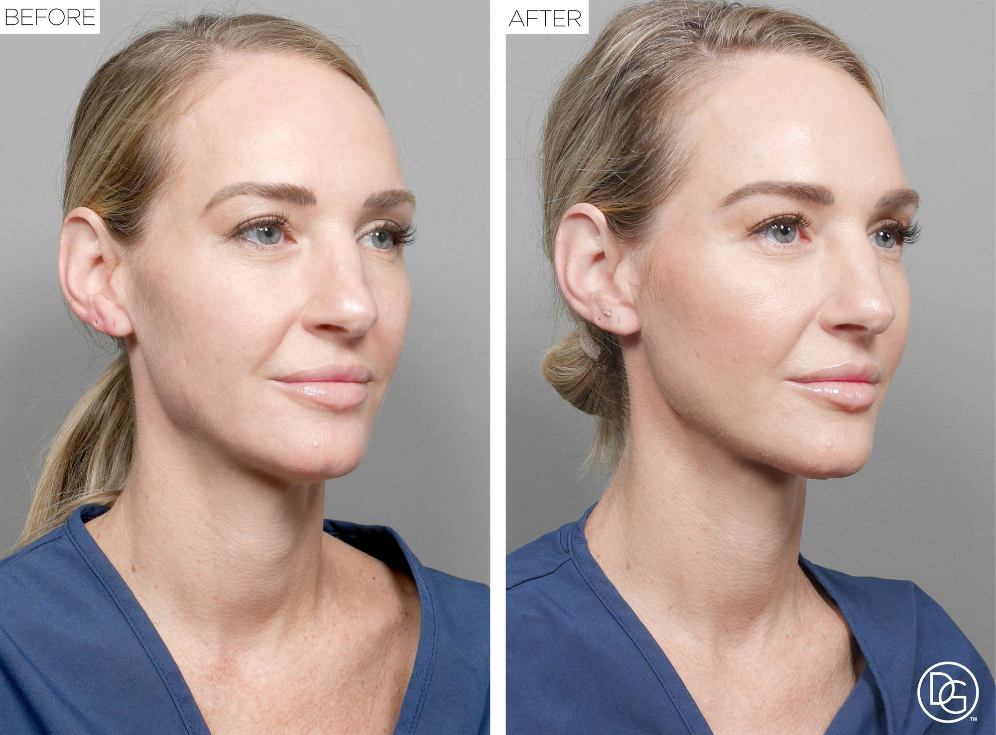 Weekend Lift Before & After Image