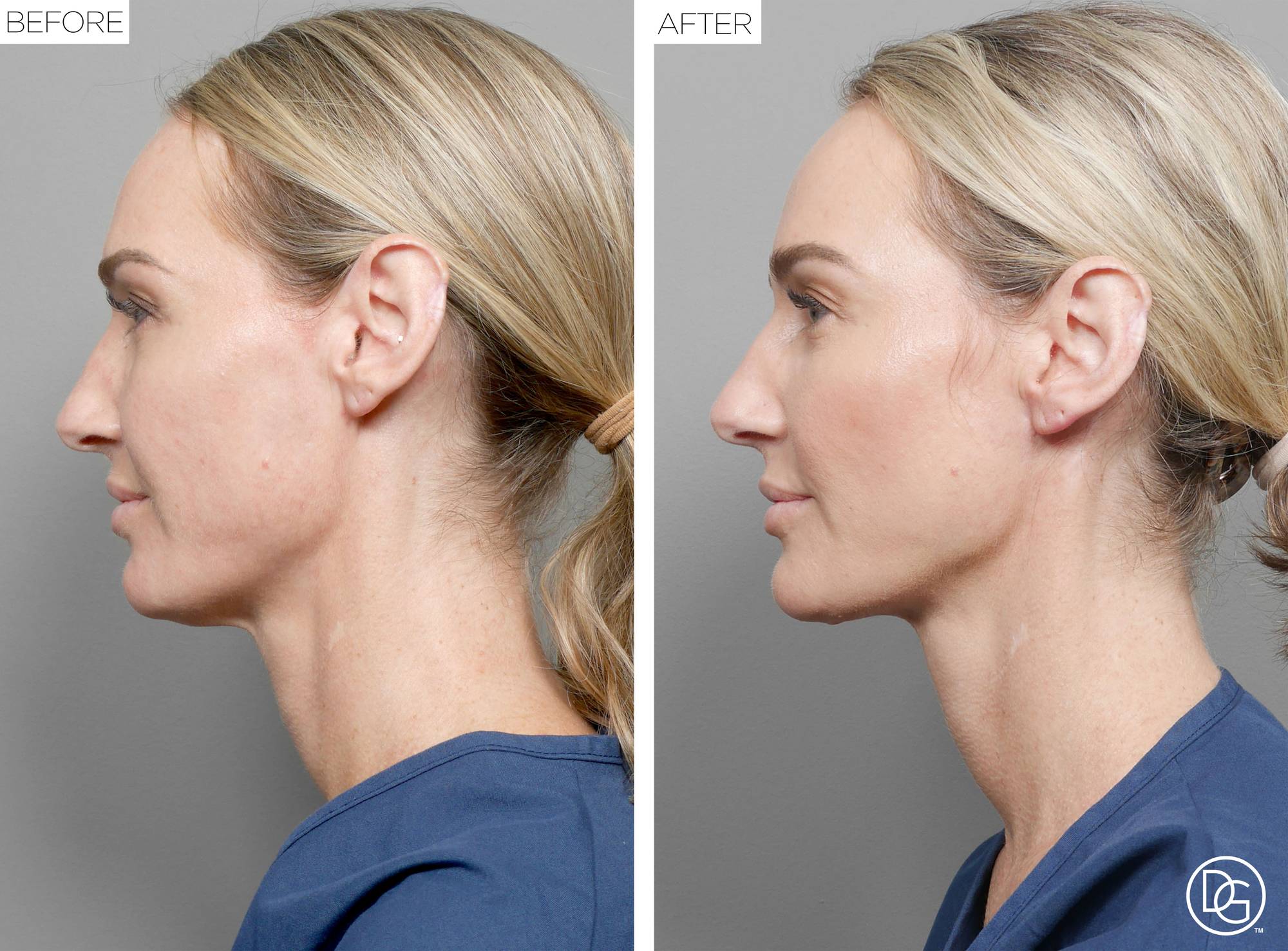 Weekend Lift Before & After Image